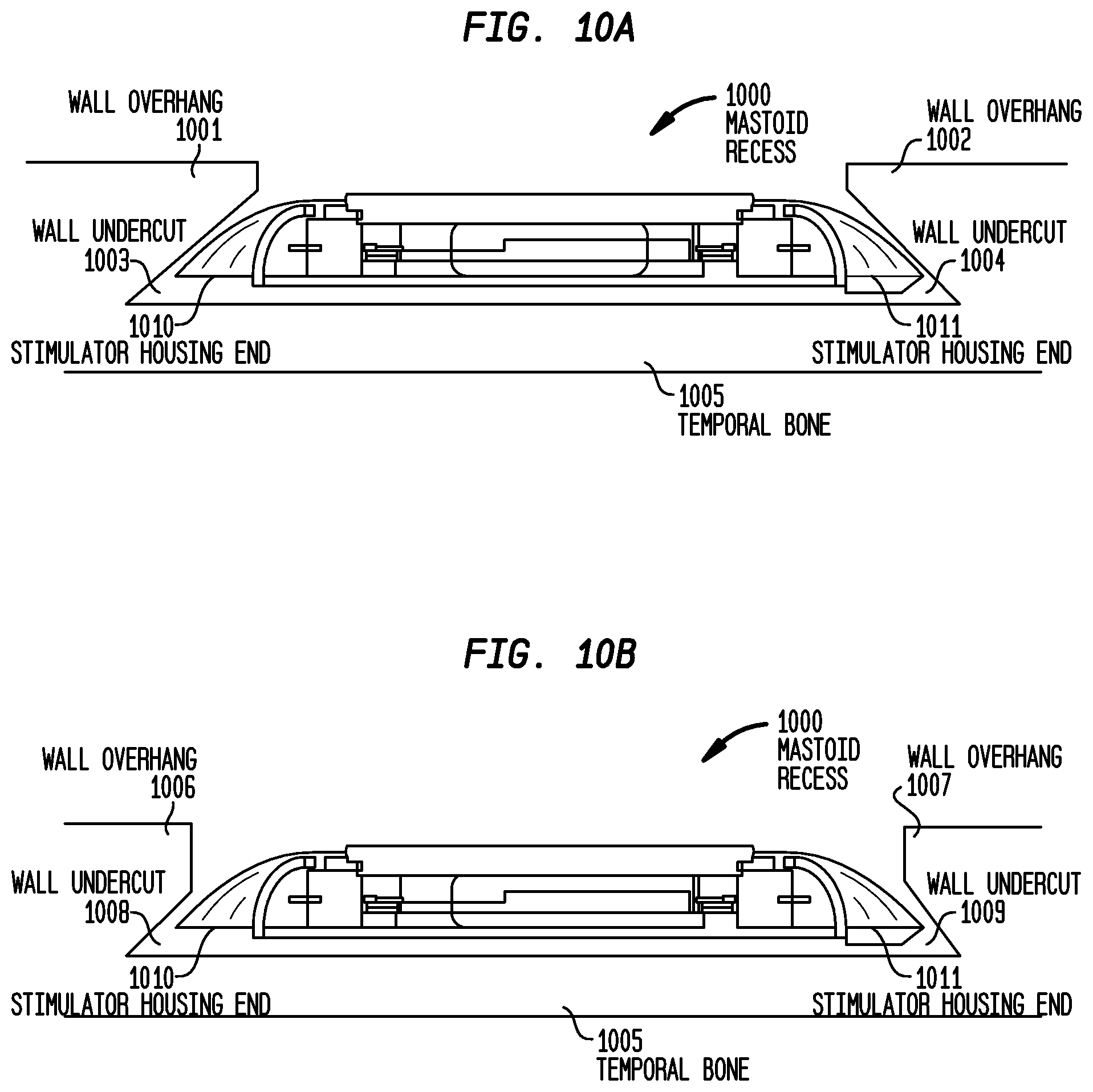 Patent US12318605 Figure 13 – Implantable device migration control