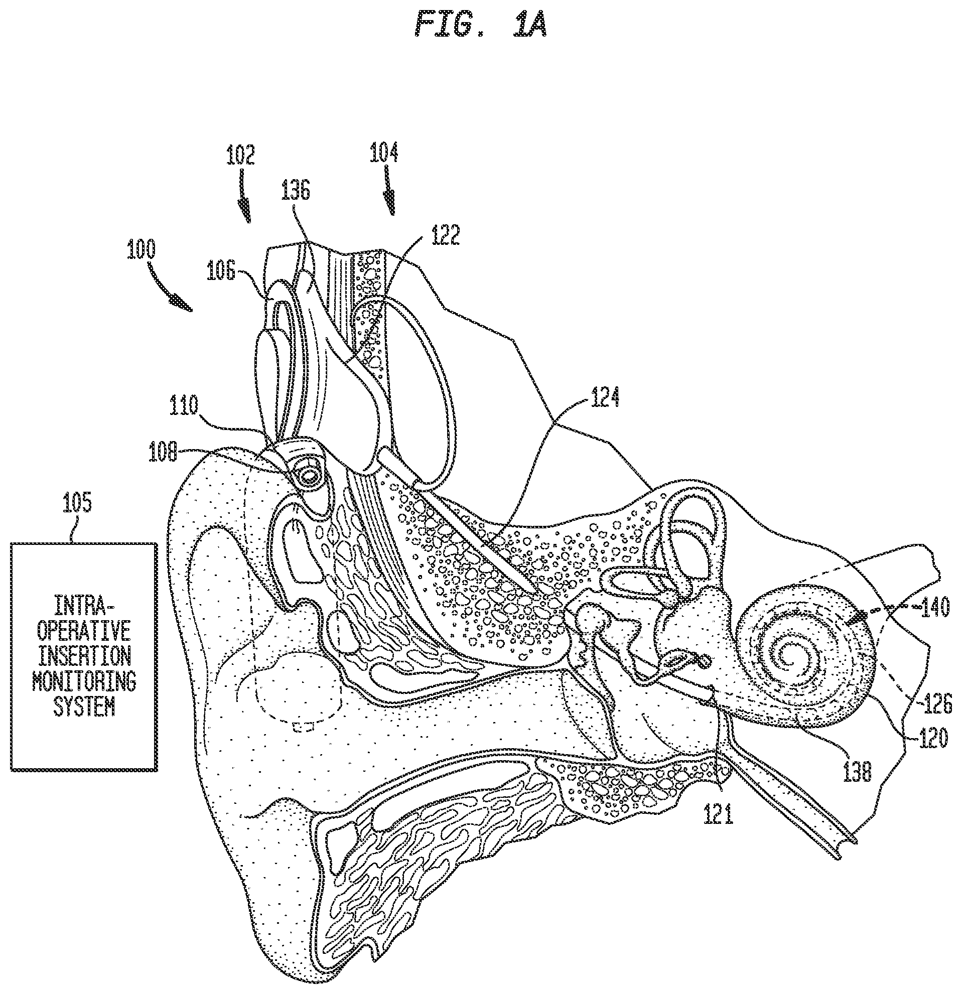 Patent US12318606 Figure 1 – Monitoring stimulating assembly insertion