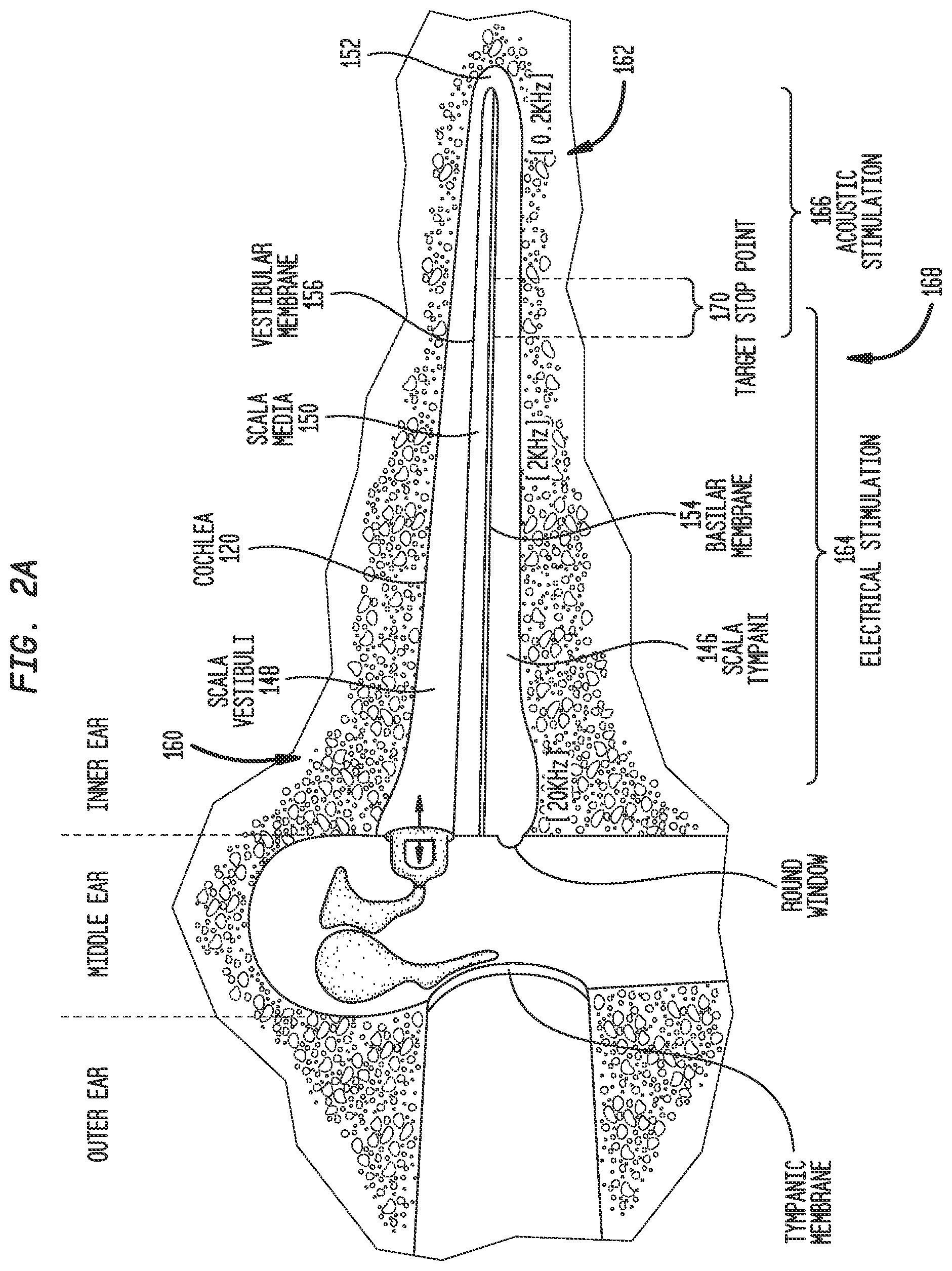 Patent US12318606 Figure 3 – Monitoring stimulating assembly insertion