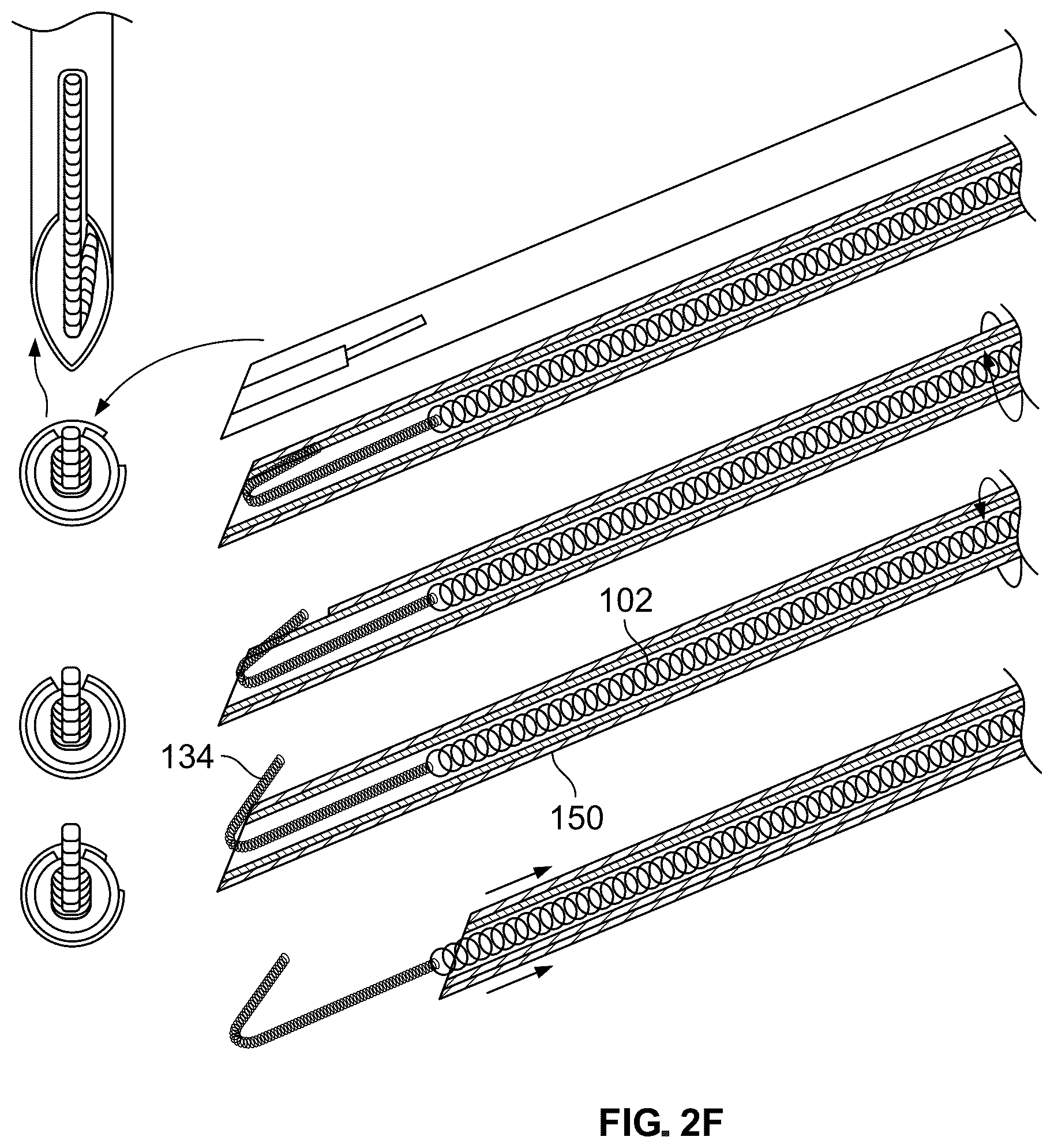 Patent US12318609 Figure 7 – Apparatus and method for positioning, implanting and using a stimulation lead