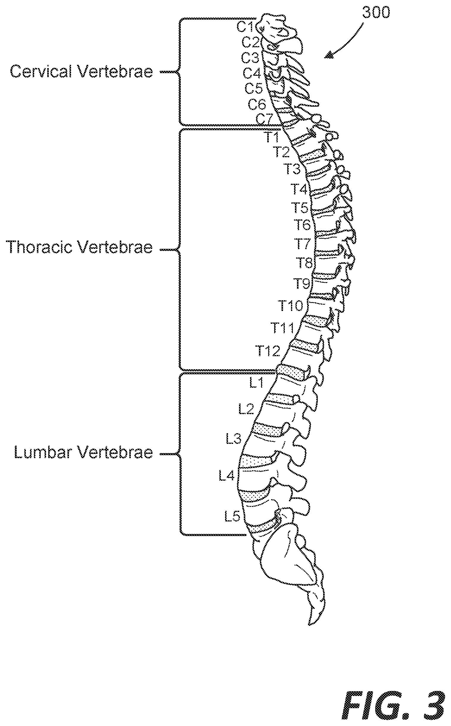 Patent US12318611 Figure 3 – Treating lung disease with spinal cord stimulation