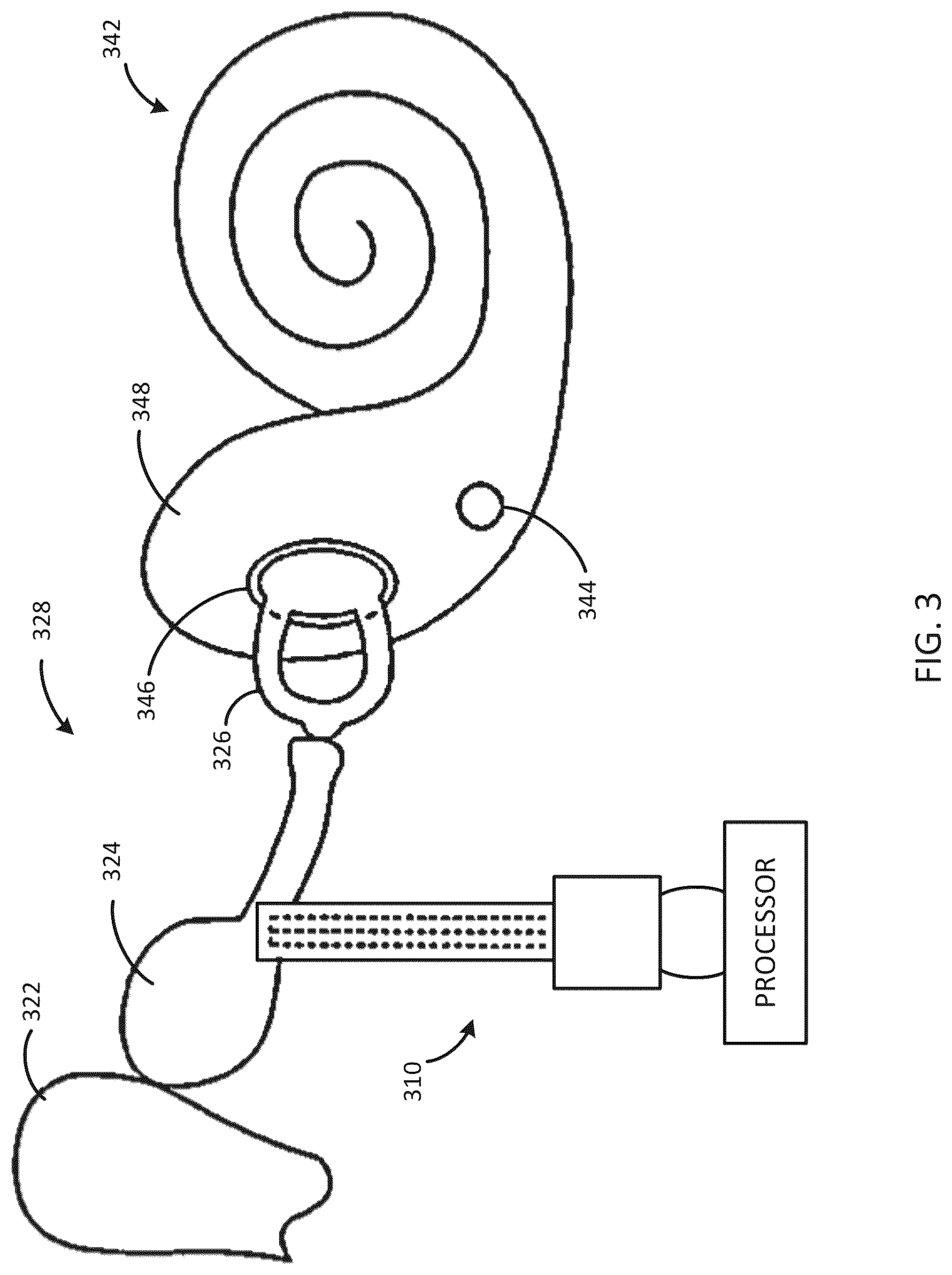 Patent US12318613 Figure 3 – Cochlear implant system with integrated signal analysis functionality