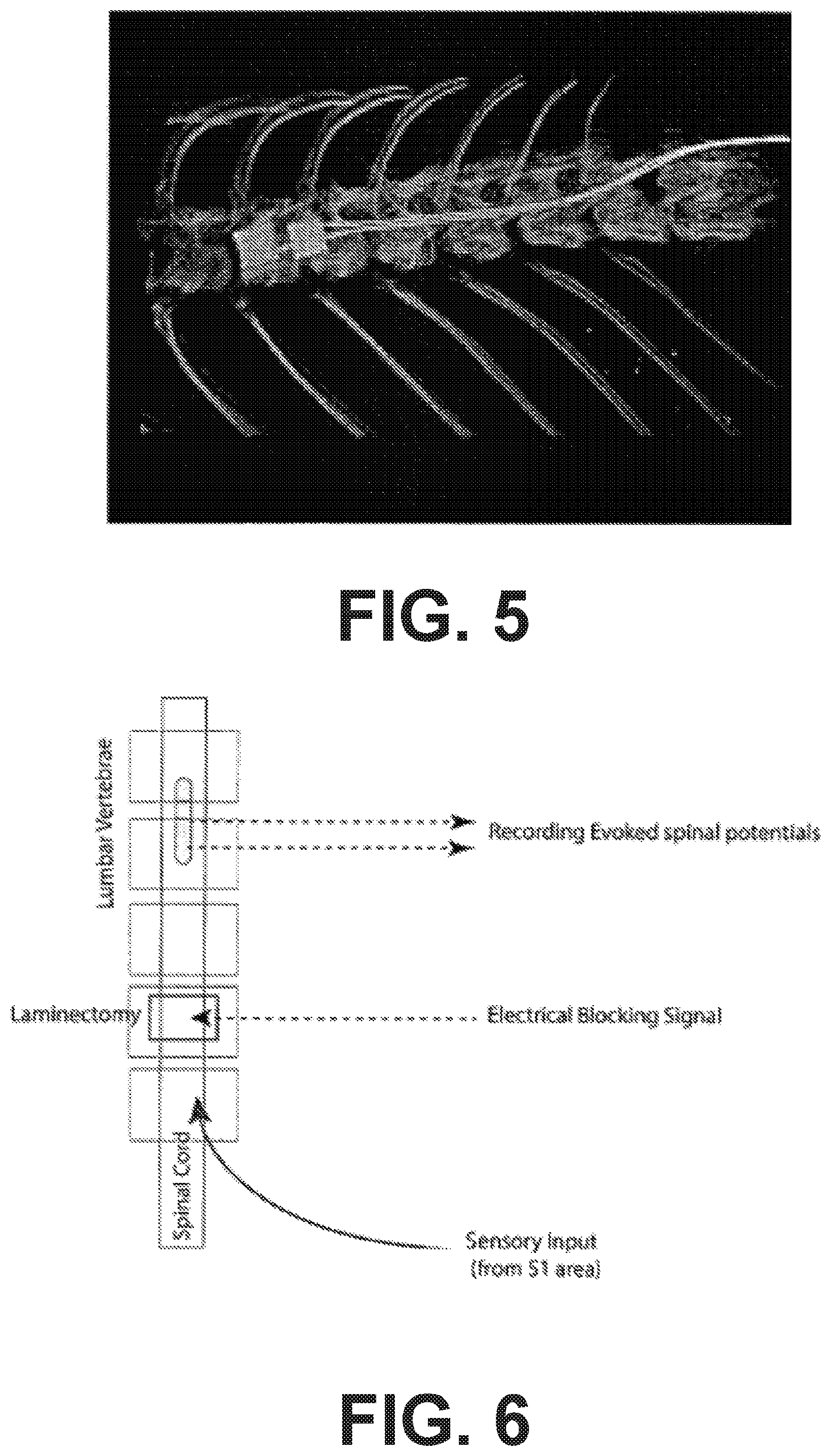 Patent US12318614 Figure 4 – Intravertebral direct current block of spinal transmission of neural signals