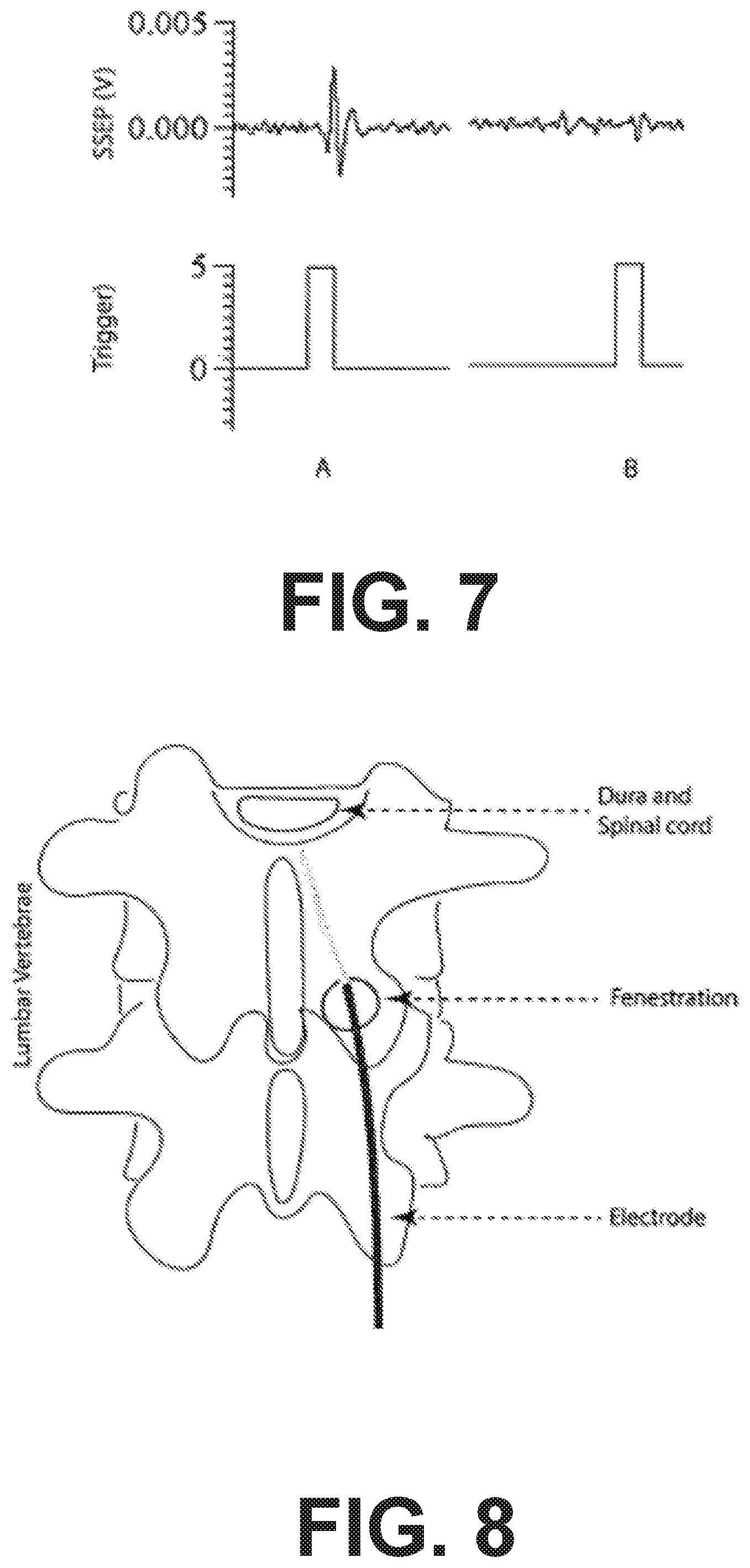 Patent US12318614 Figure 5 – Intravertebral direct current block of spinal transmission of neural signals
