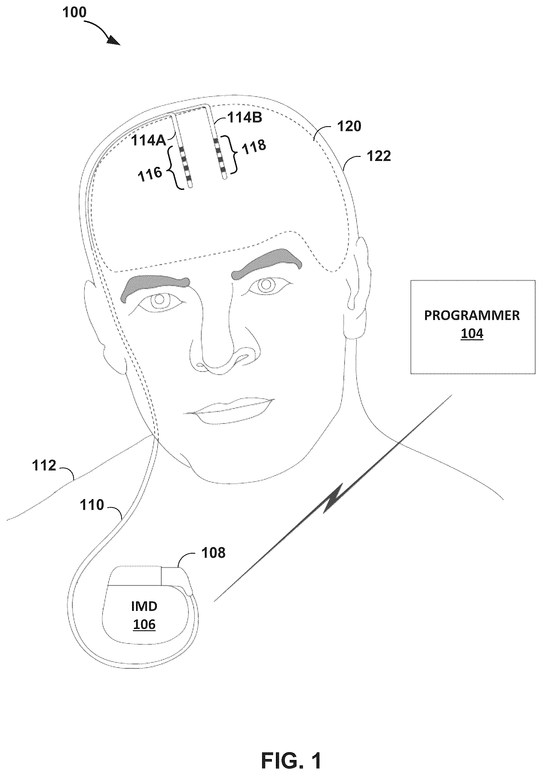Patent US12318617 Figure 1 – Electrical stimulation therapy
