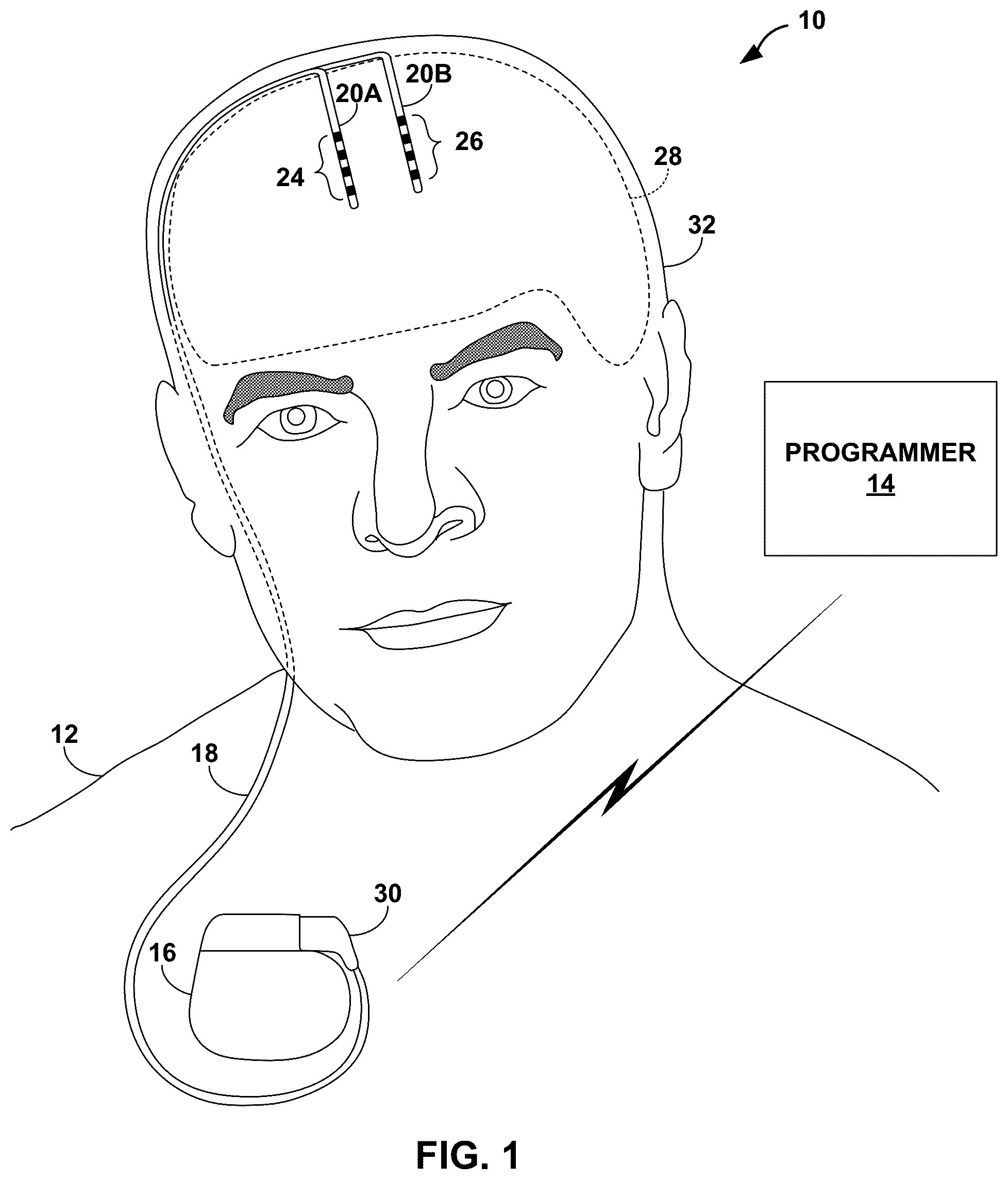 Patent US12318619 Figure 1 – Medical leads and techniques for manufacturing the same