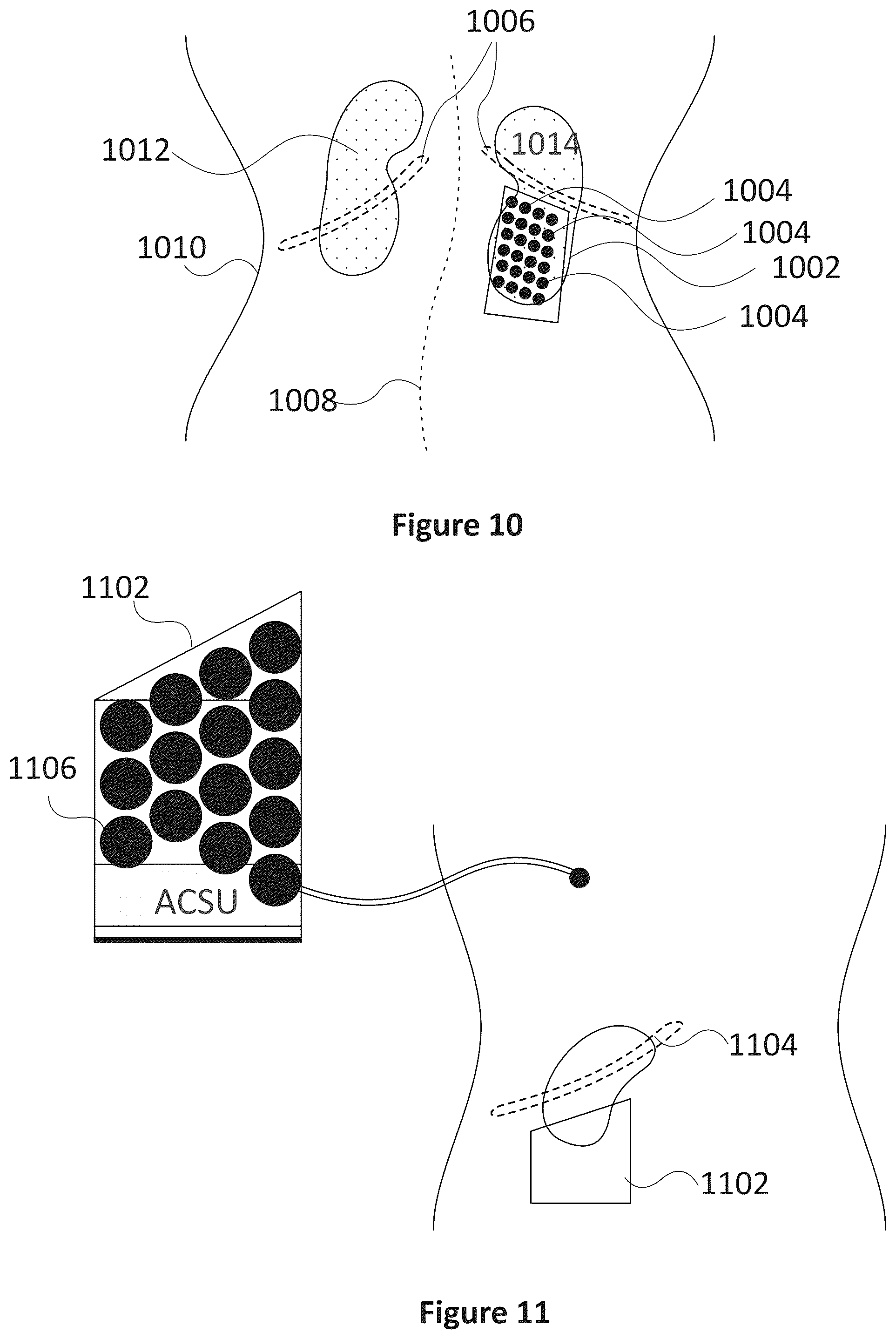 Patent US12318635 Figure 10 – Apparatus and method for treating kidneys