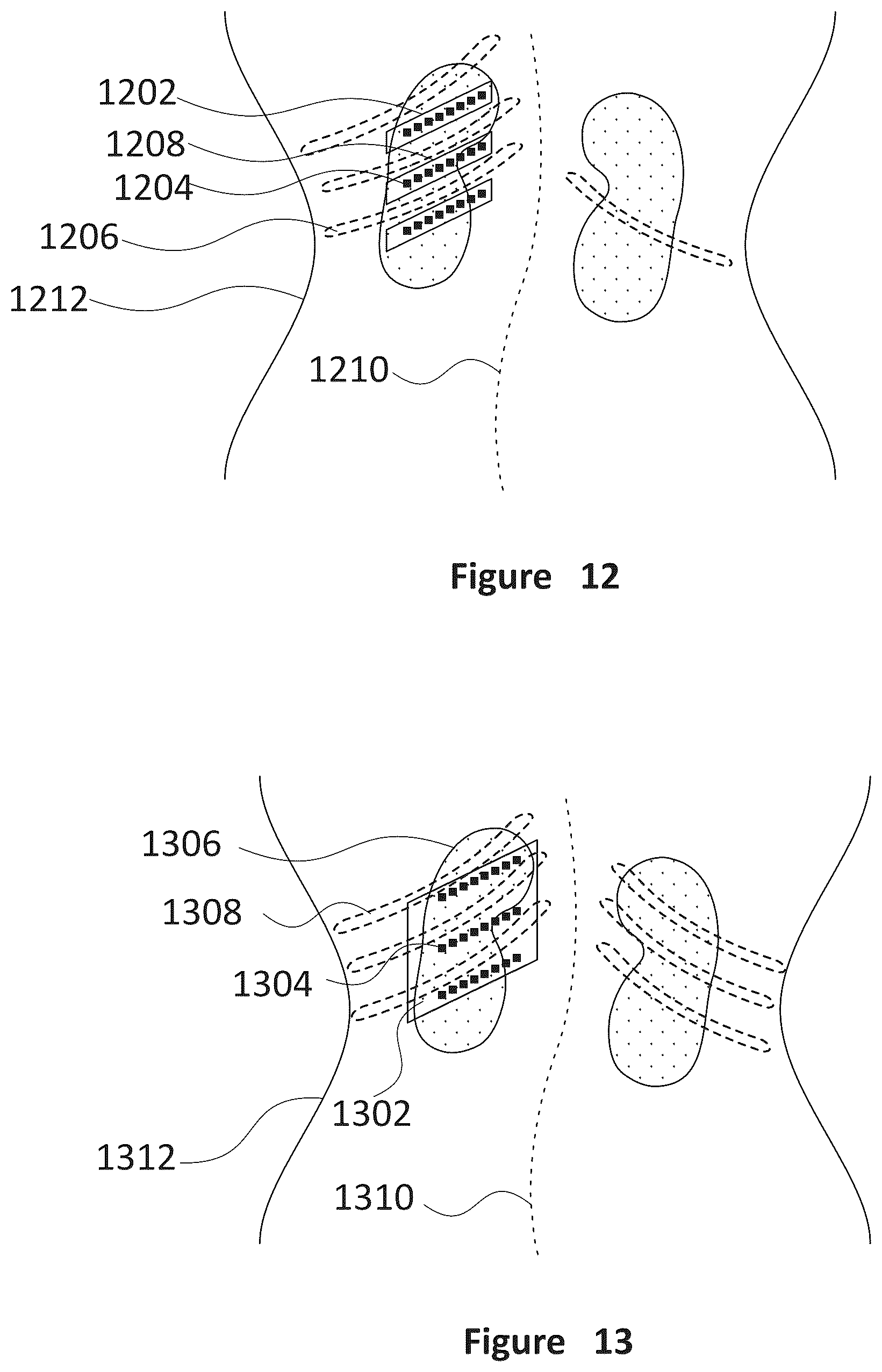 Patent US12318635 Figure 11 – Apparatus and method for treating kidneys