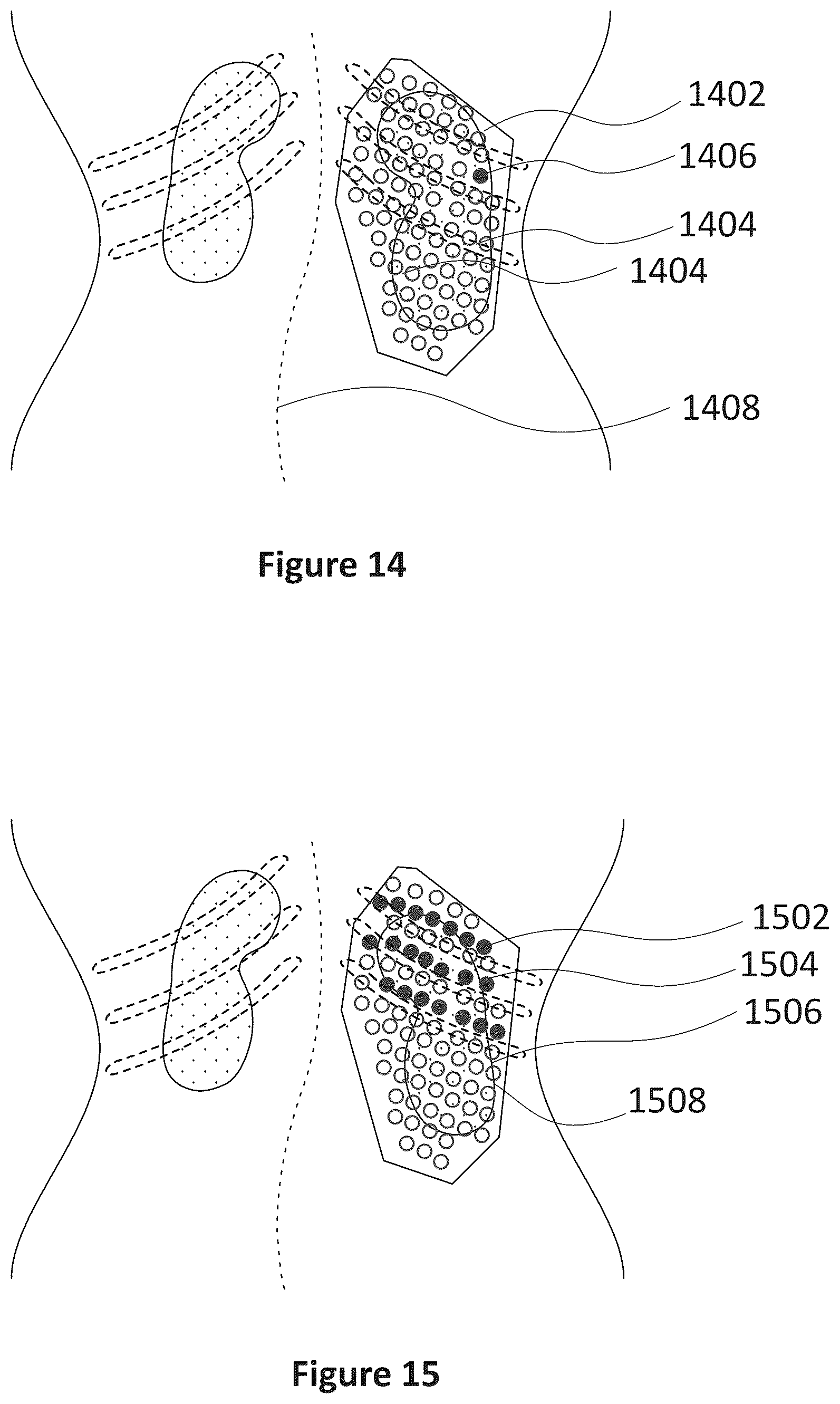 Patent US12318635 Figure 12 – Apparatus and method for treating kidneys