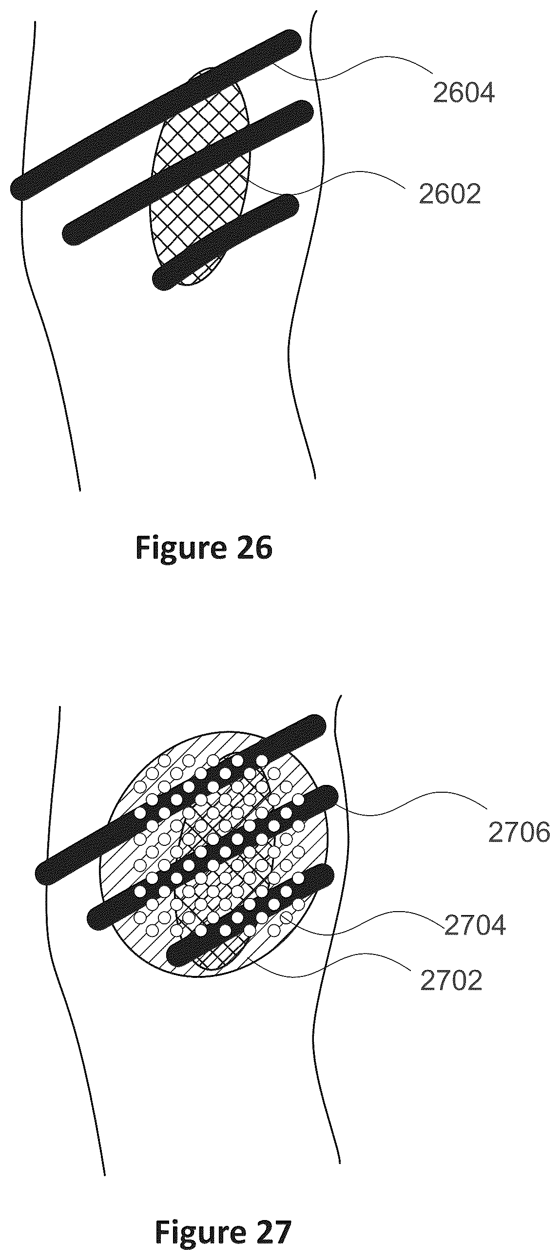 Patent US12318635 Figure 18 – Apparatus and method for treating kidneys
