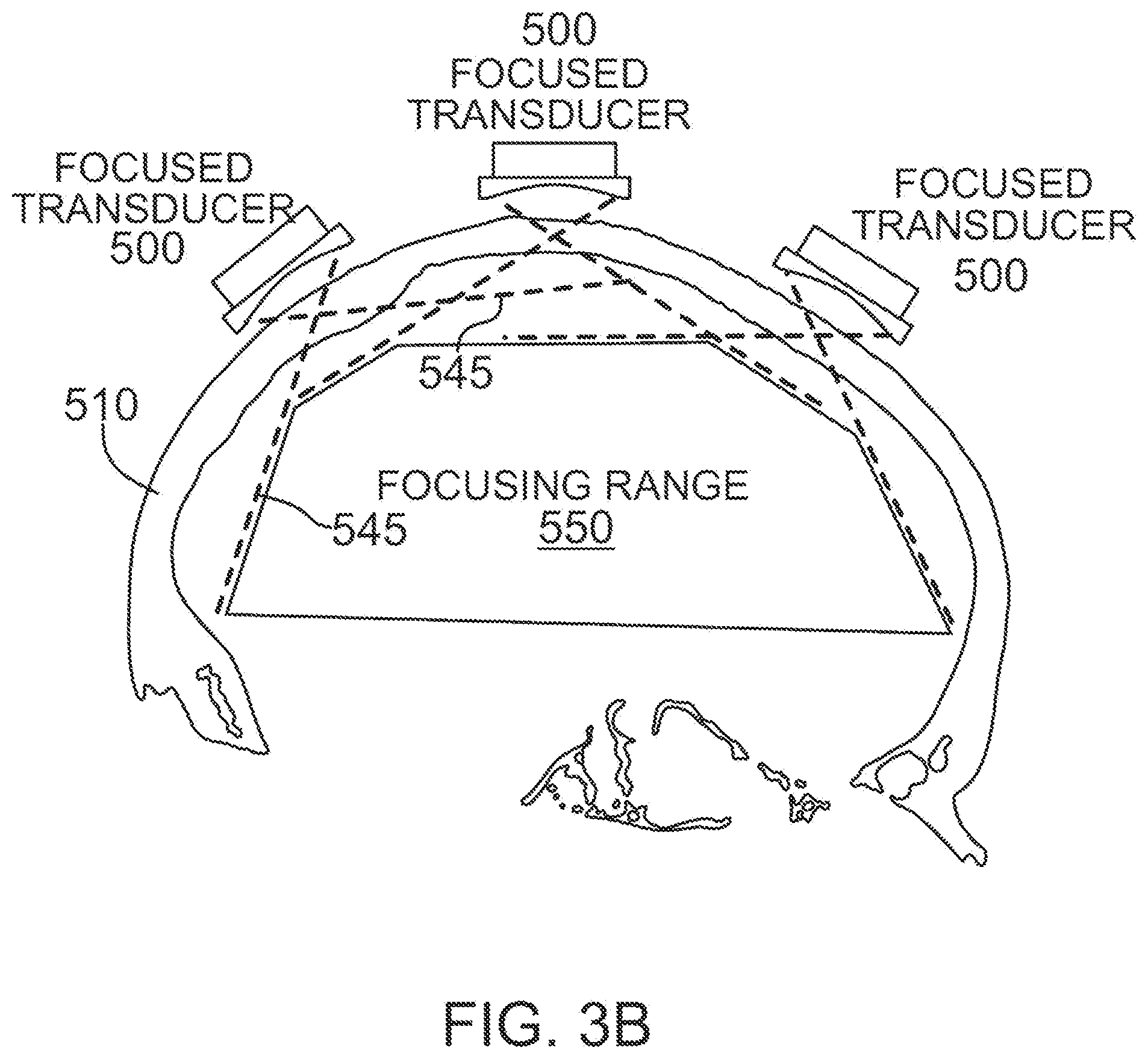 Patent US12318637 Figure 5 – Systems and methods for reducing thermal skull-induced aberrations during transcranial ultrasound therapeutic procedures