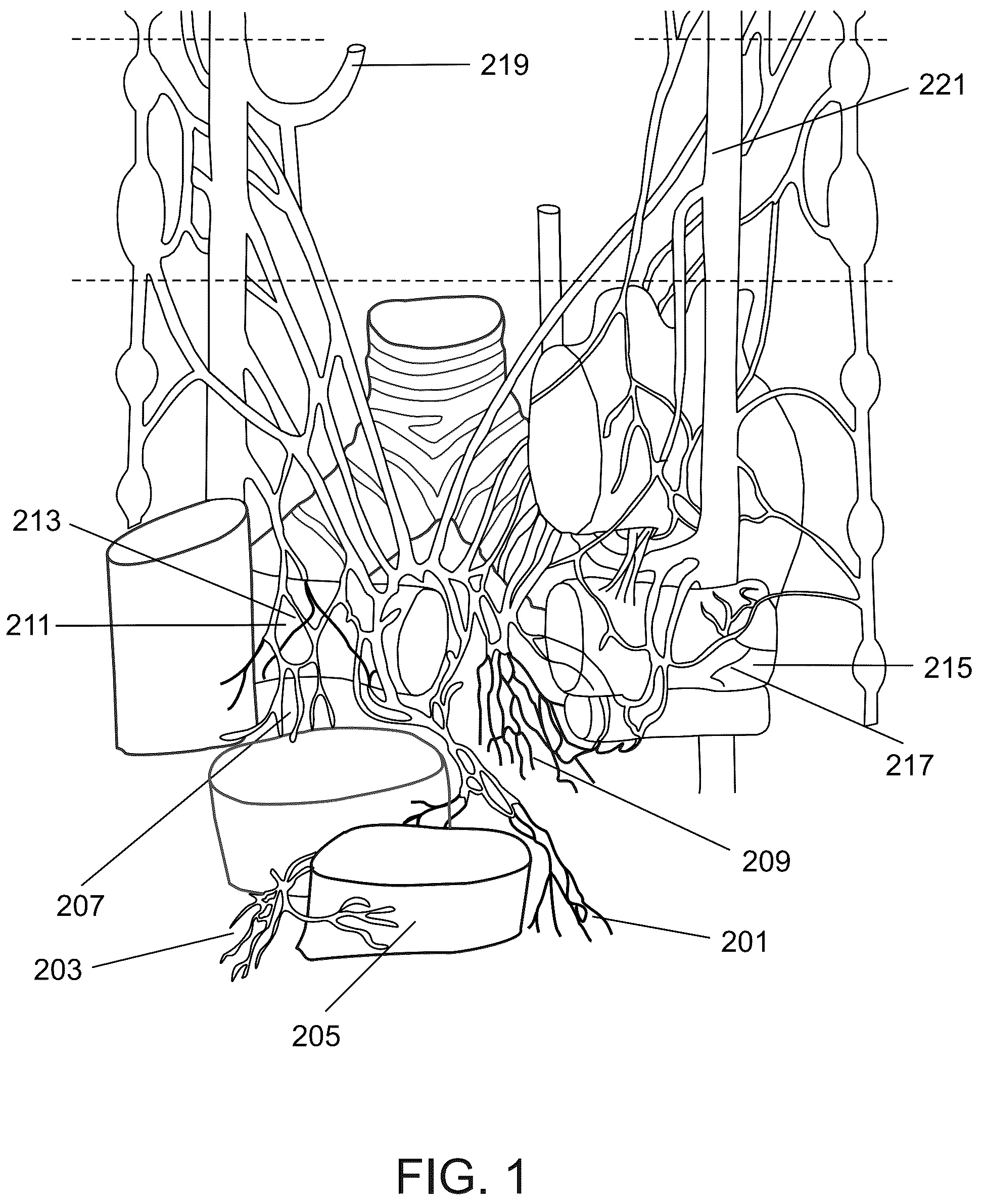 Patent US12318638 Figure 1 – Devices and methods for reducing parasympathetic nerve activity in patients with a respiratory syndrome