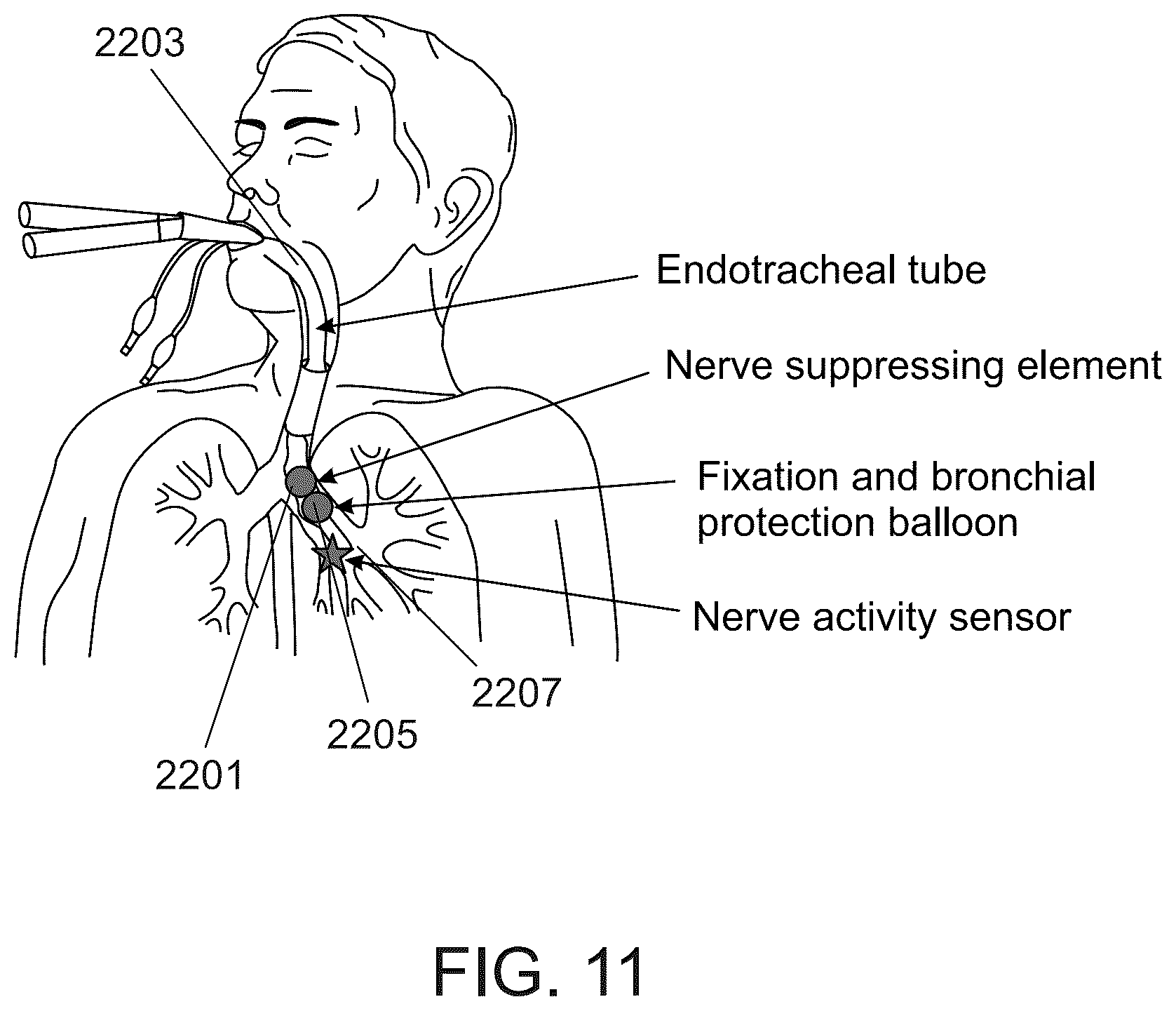 Patent US12318638 Figure 13 – Devices and methods for reducing parasympathetic nerve activity in patients with a respiratory syndrome