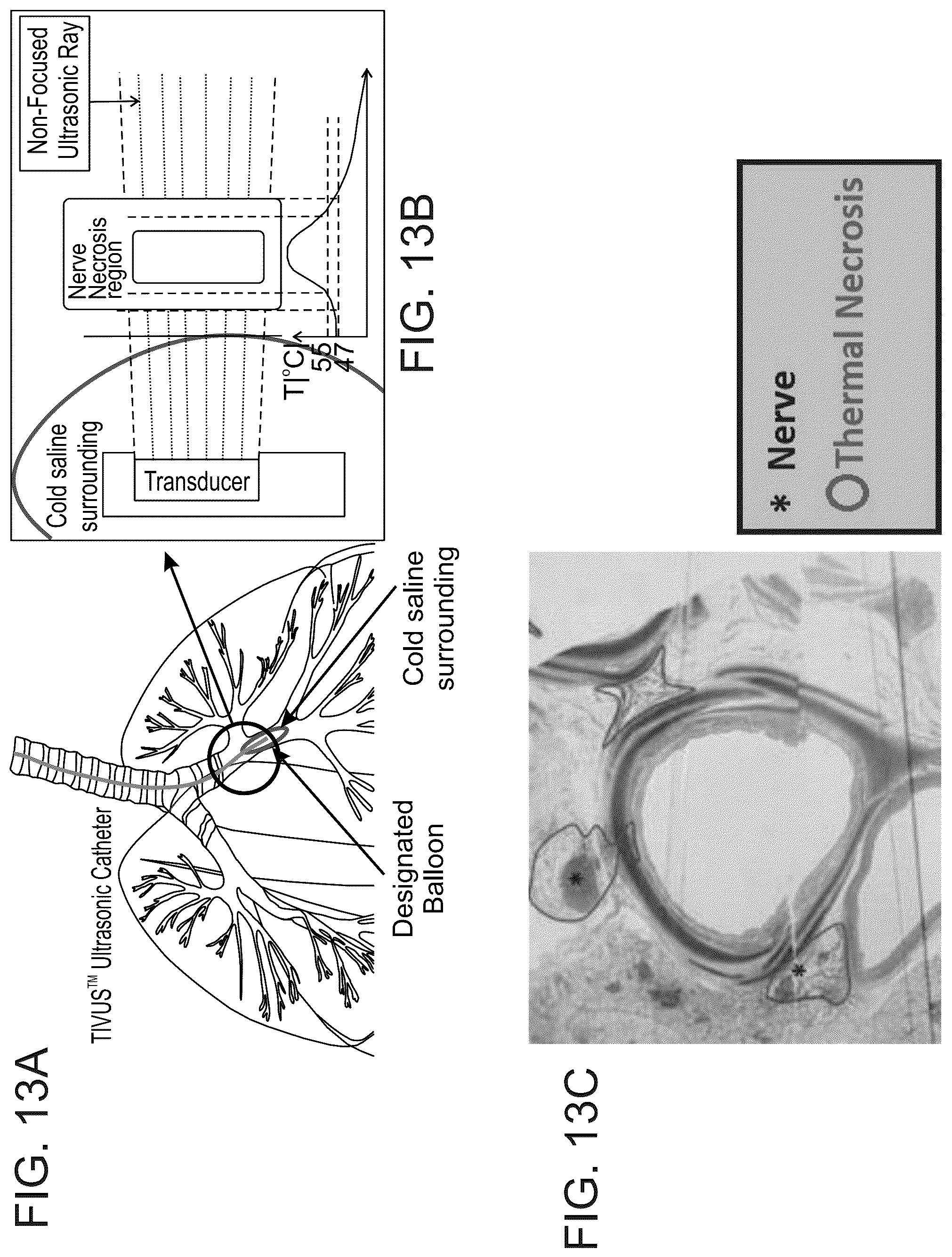 Patent US12318638 Figure 15 – Devices and methods for reducing parasympathetic nerve activity in patients with a respiratory syndrome