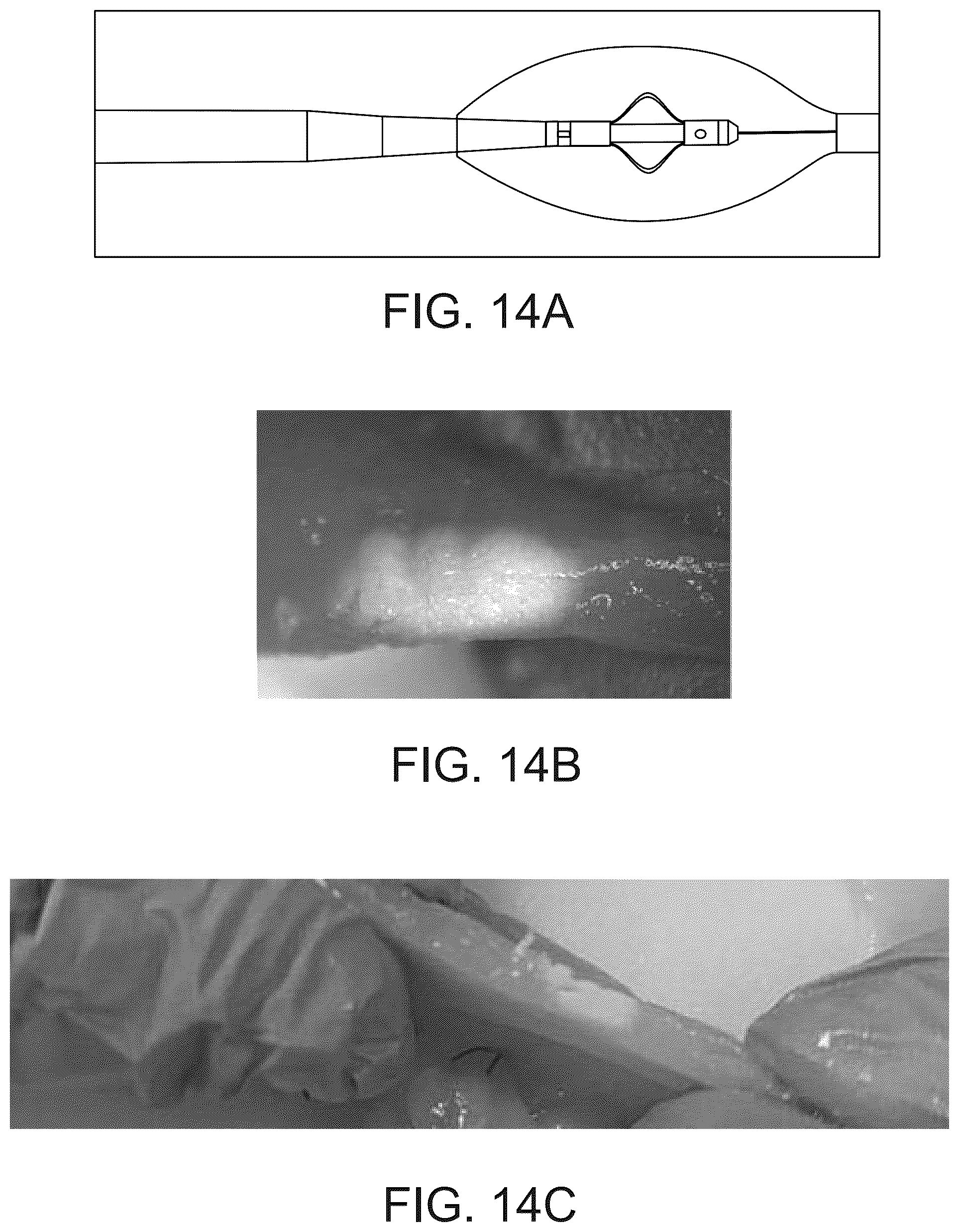 Patent US12318638 Figure 16 – Devices and methods for reducing parasympathetic nerve activity in patients with a respiratory syndrome