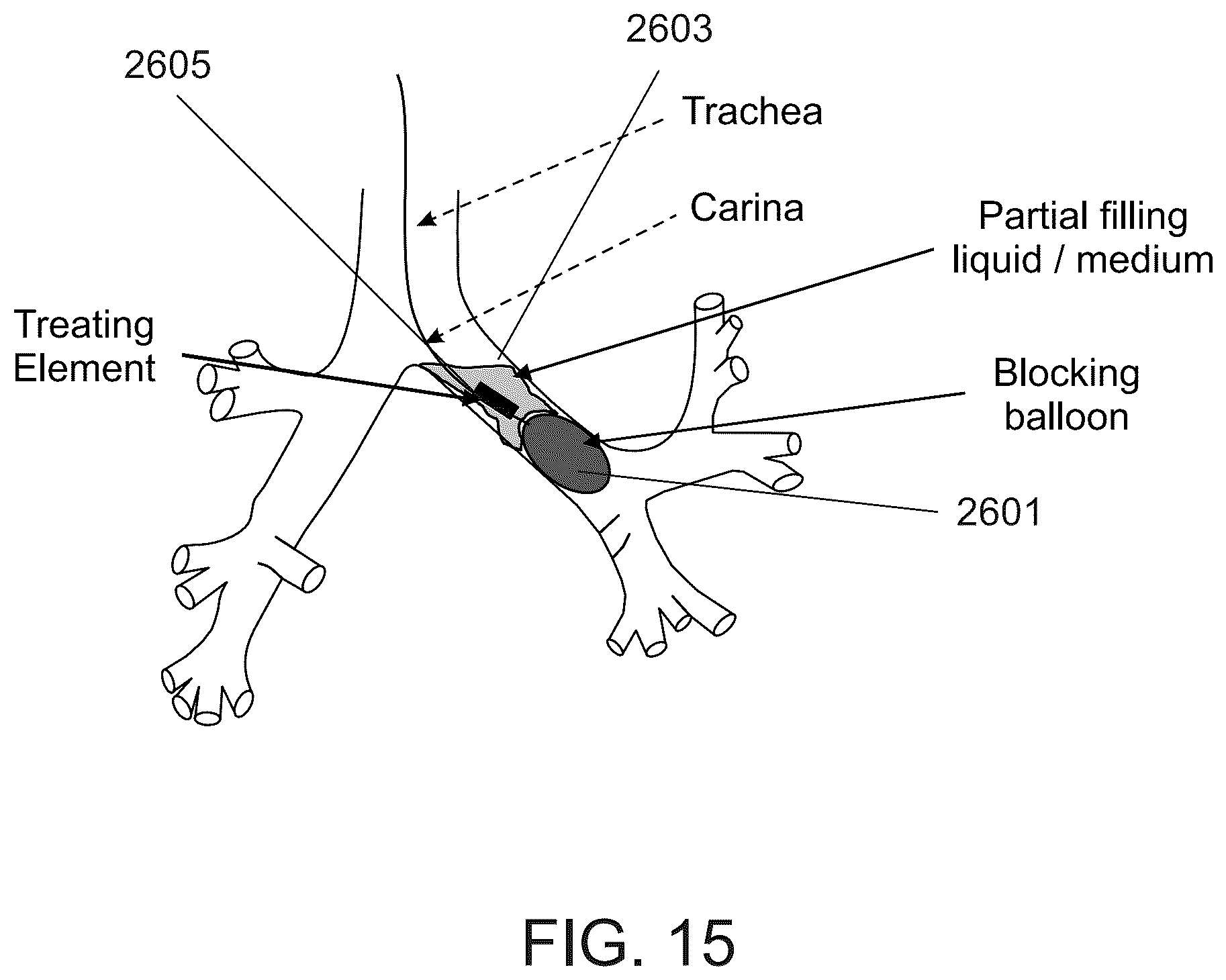 Patent US12318638 Figure 17 – Devices and methods for reducing parasympathetic nerve activity in patients with a respiratory syndrome