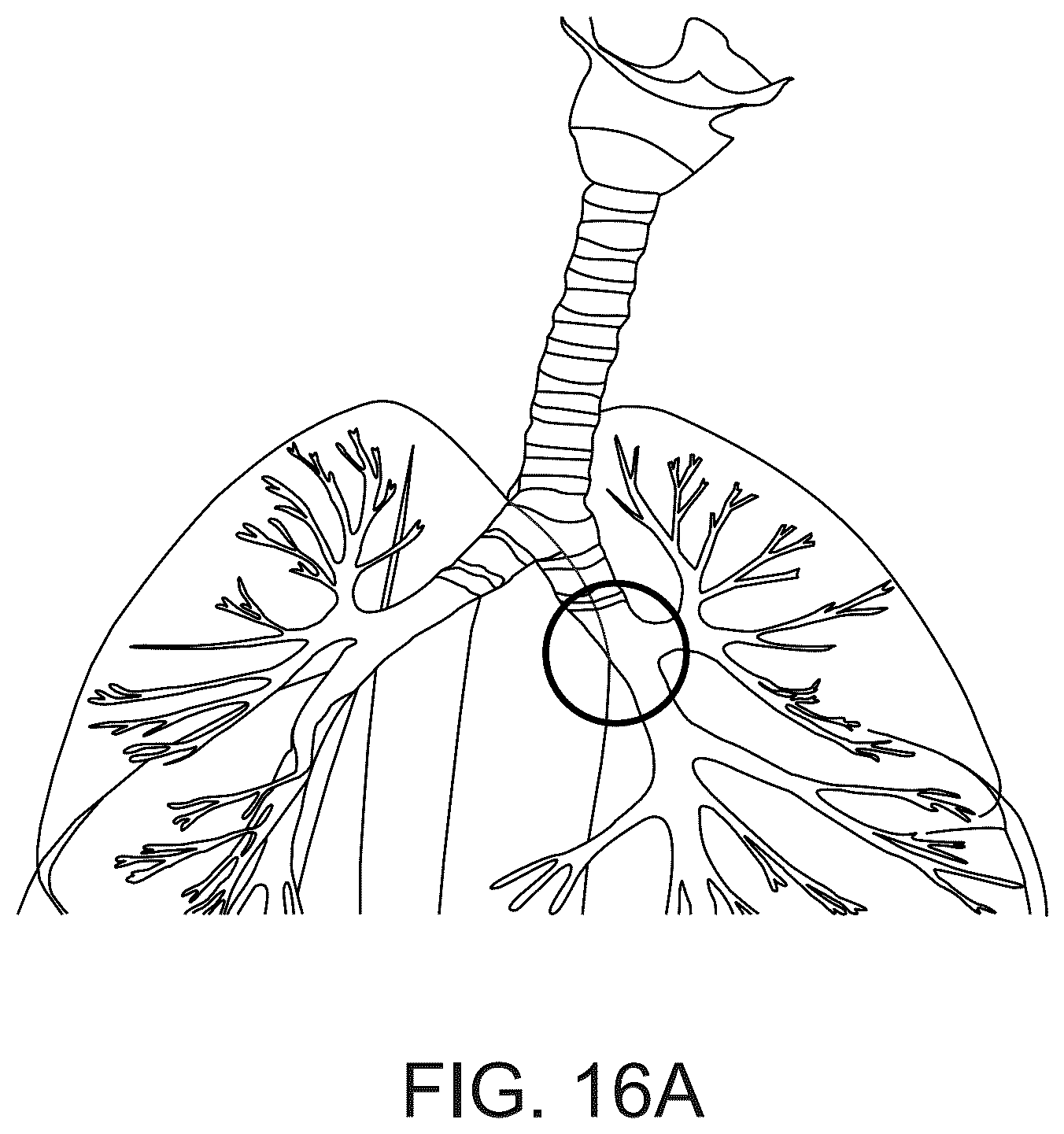 Patent US12318638 Figure 18 – Devices and methods for reducing parasympathetic nerve activity in patients with a respiratory syndrome