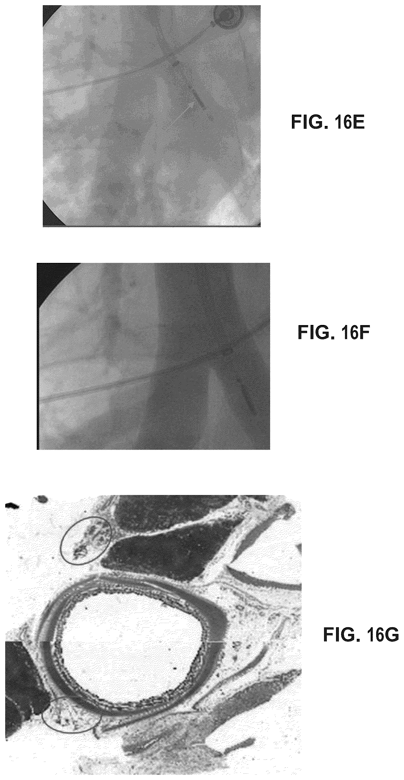 Patent US12318638 Figure 20 – Devices and methods for reducing parasympathetic nerve activity in patients with a respiratory syndrome