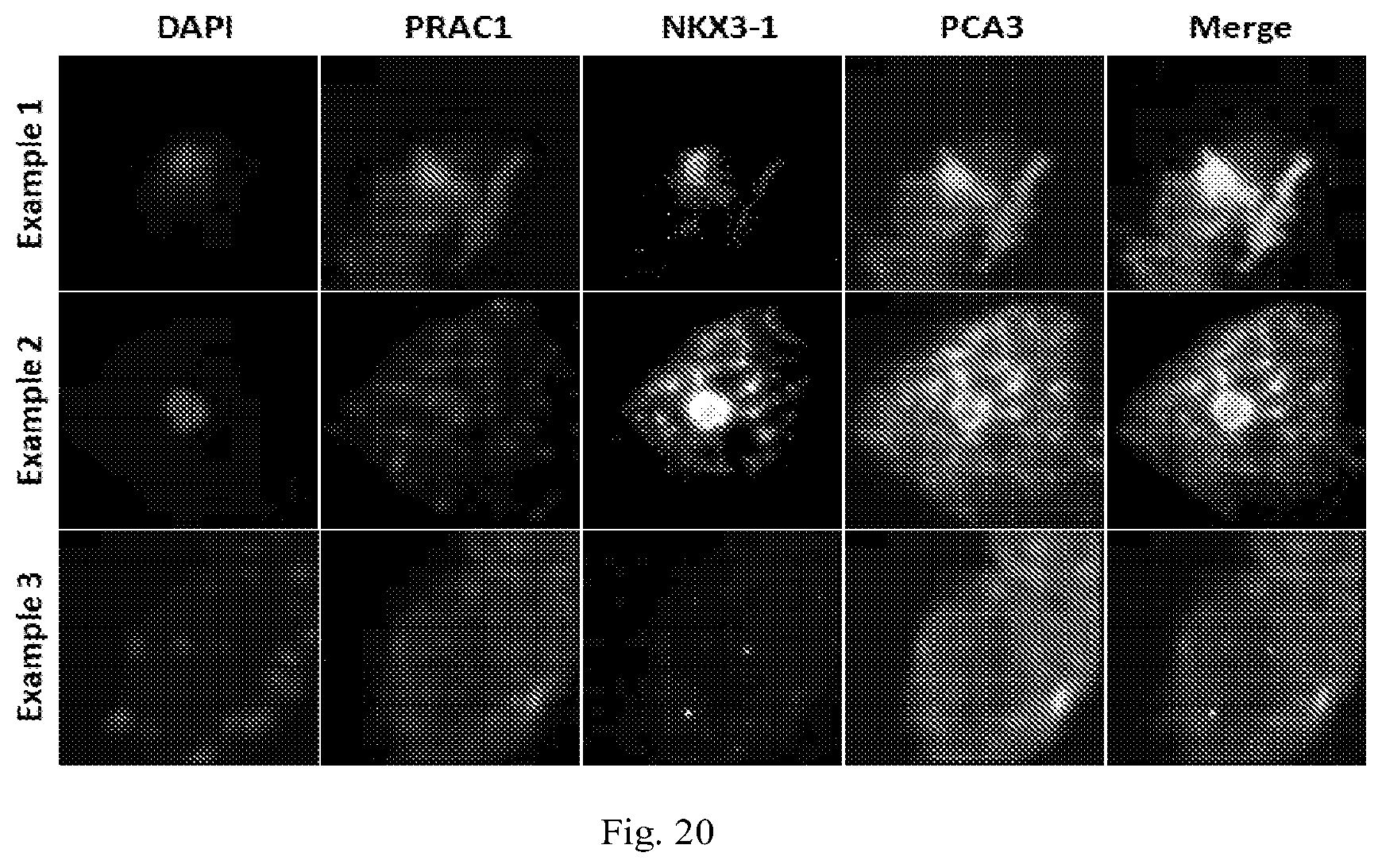 Patent US12319971 Figure 18 – Methods for prostate cancer detection