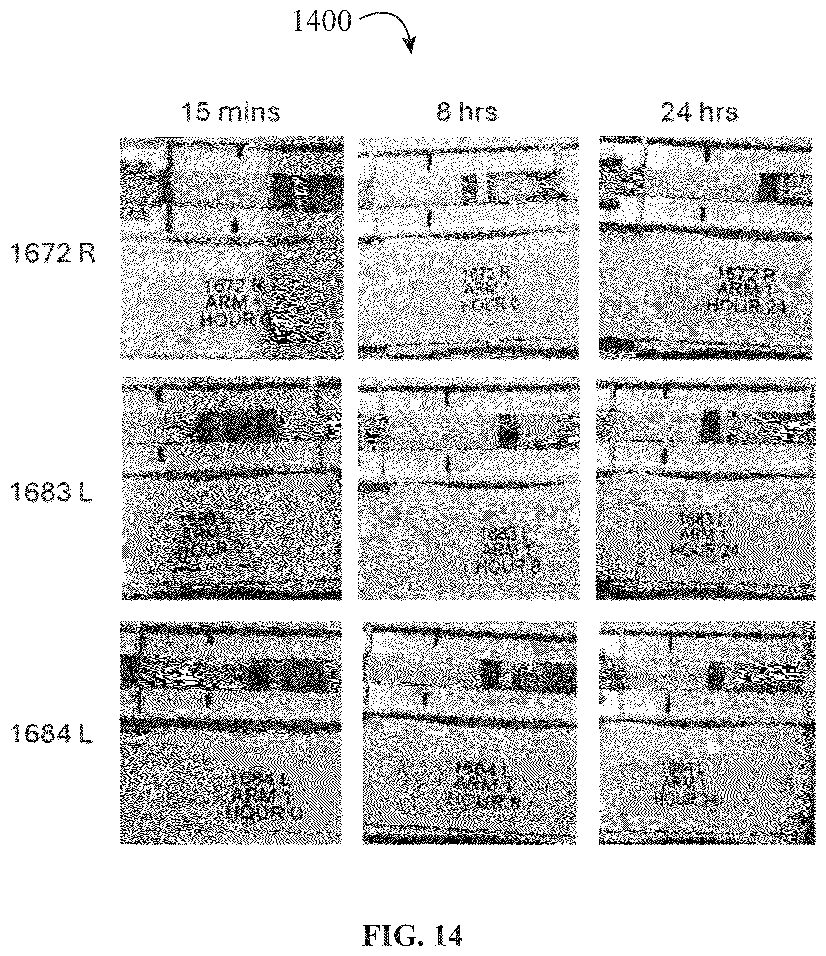 Patent US12320816 Figure 14 – Assay device for diagnosis of open-globe ocular injuries