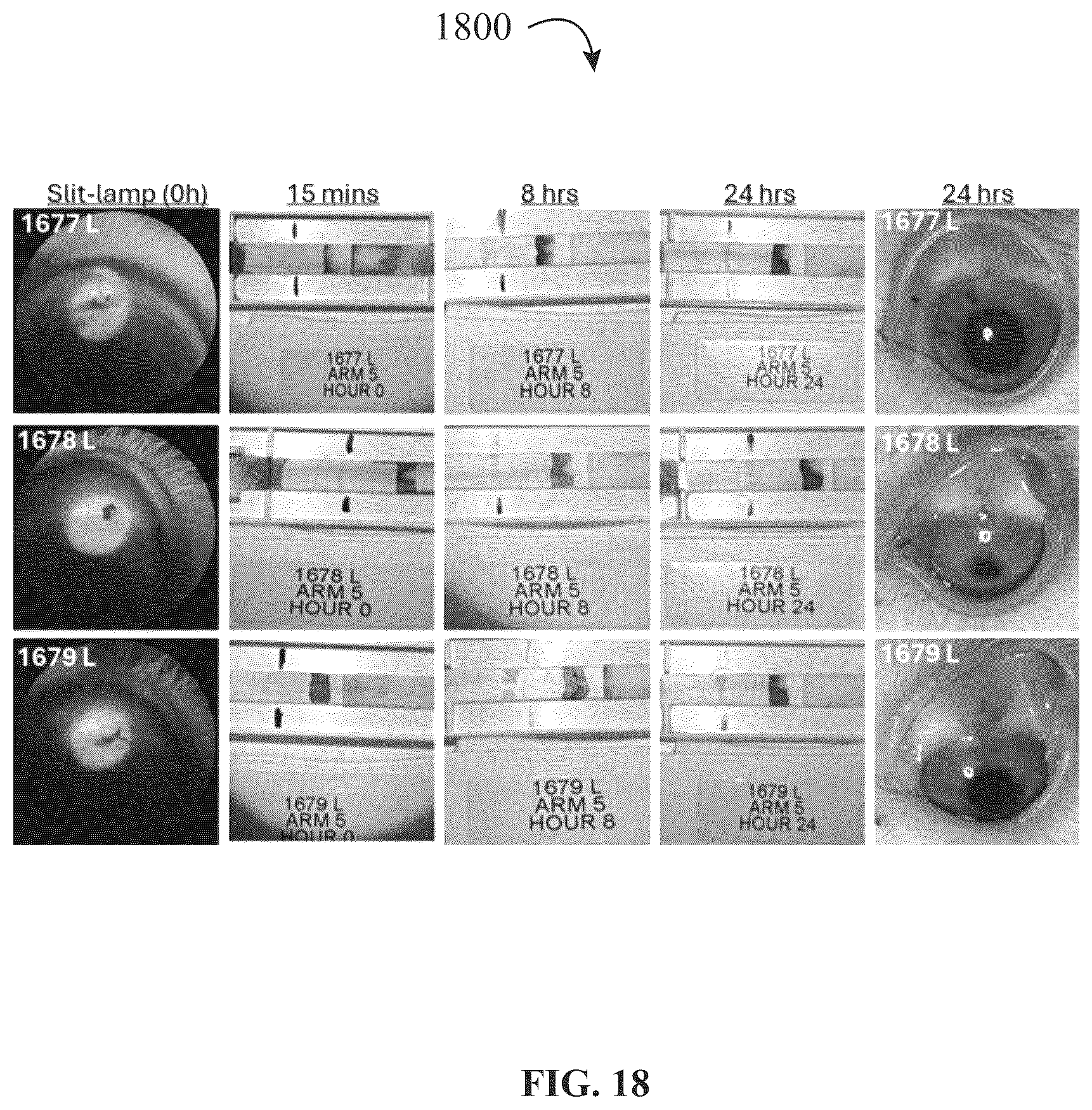 Patent US12320816 Figure 18 – Assay device for diagnosis of open-globe ocular injuries