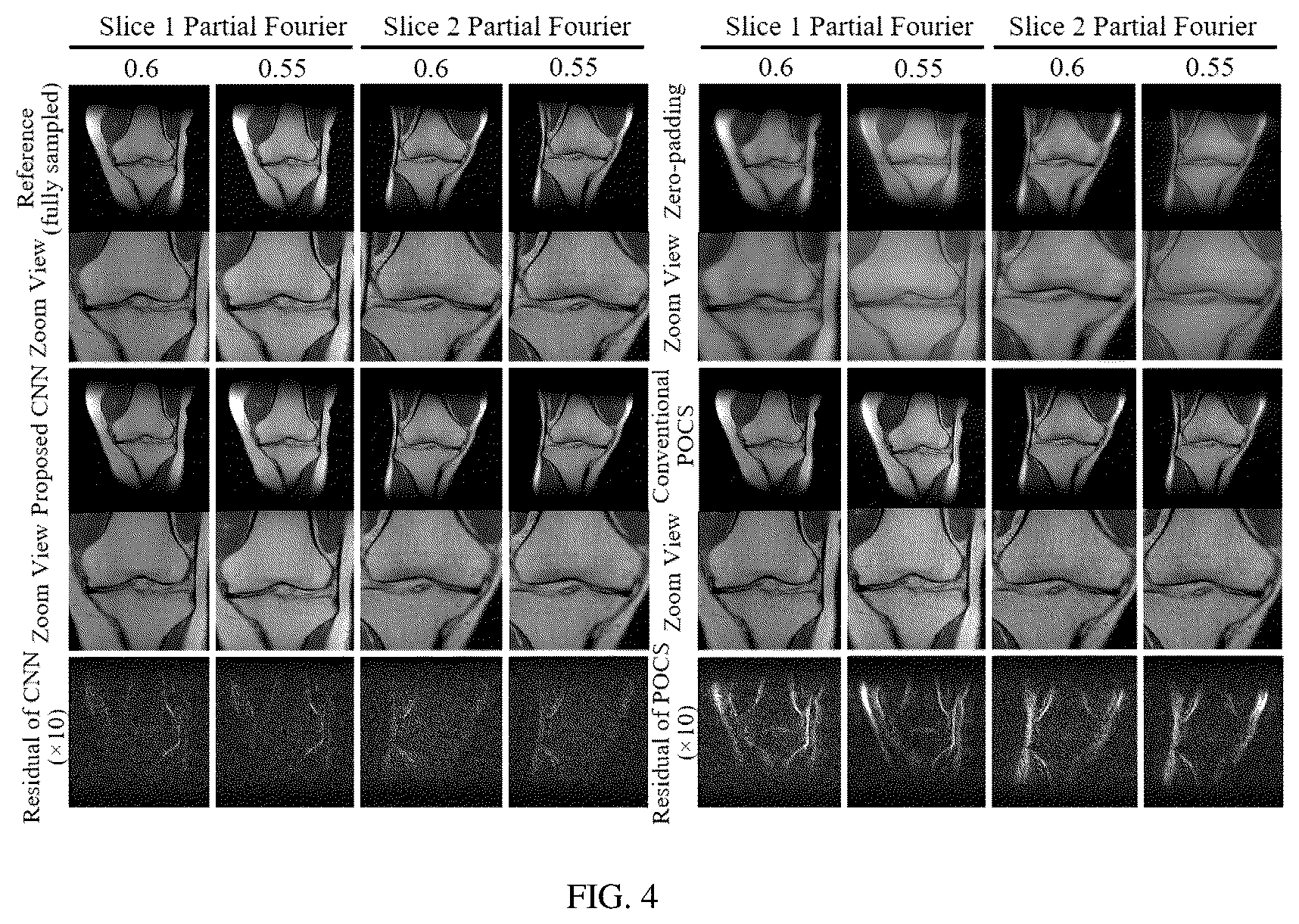 Patent US12320878 Figure 5 – Systems and methods for magnetic resonance image reconstruction from incomplete k-space data