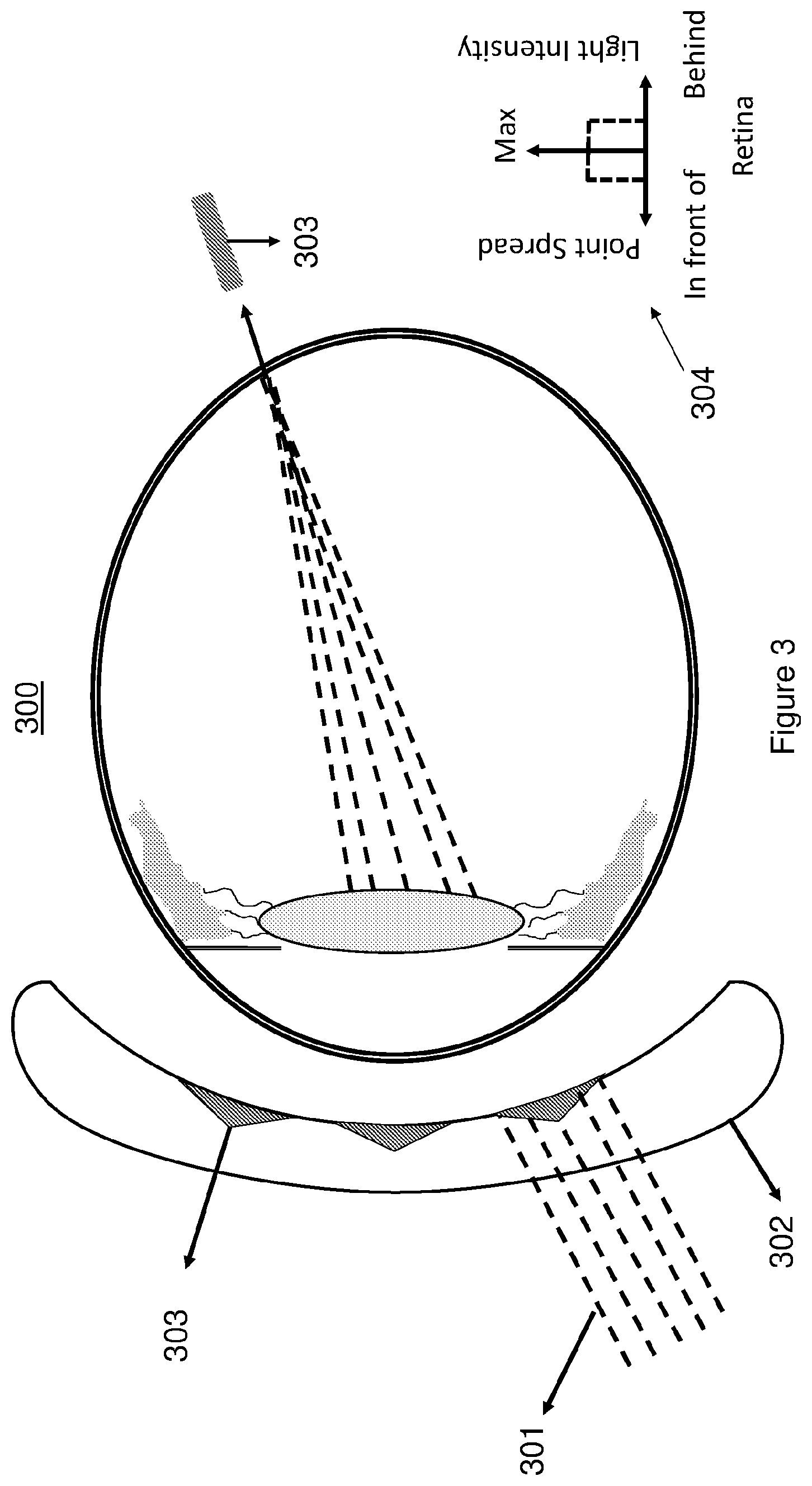 Patent US12321046 Figure 3 – Spectacle lenses with auxiliary optical elements