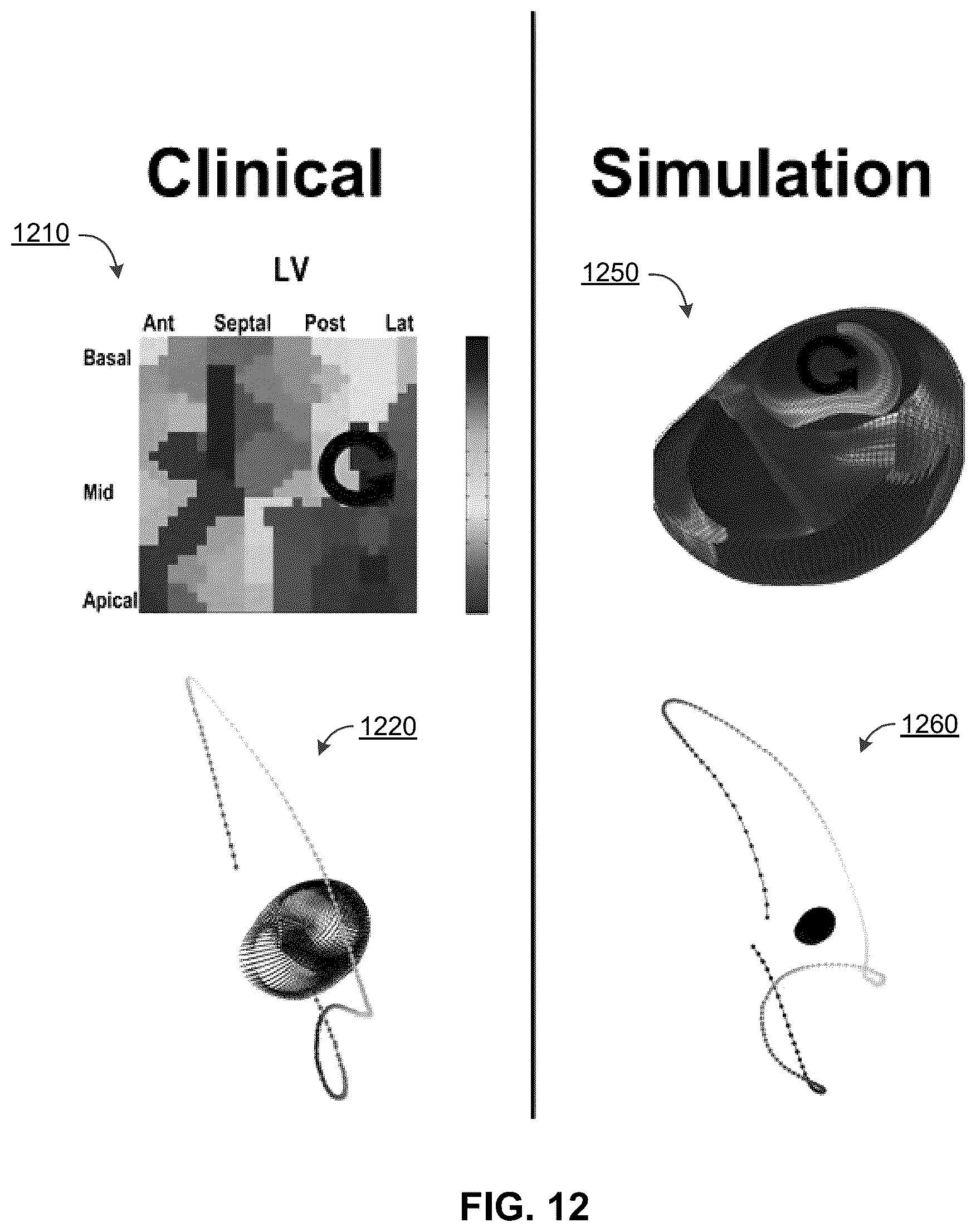 Patent US12322044 Figure 12 – Computational localization of fibrillation sources