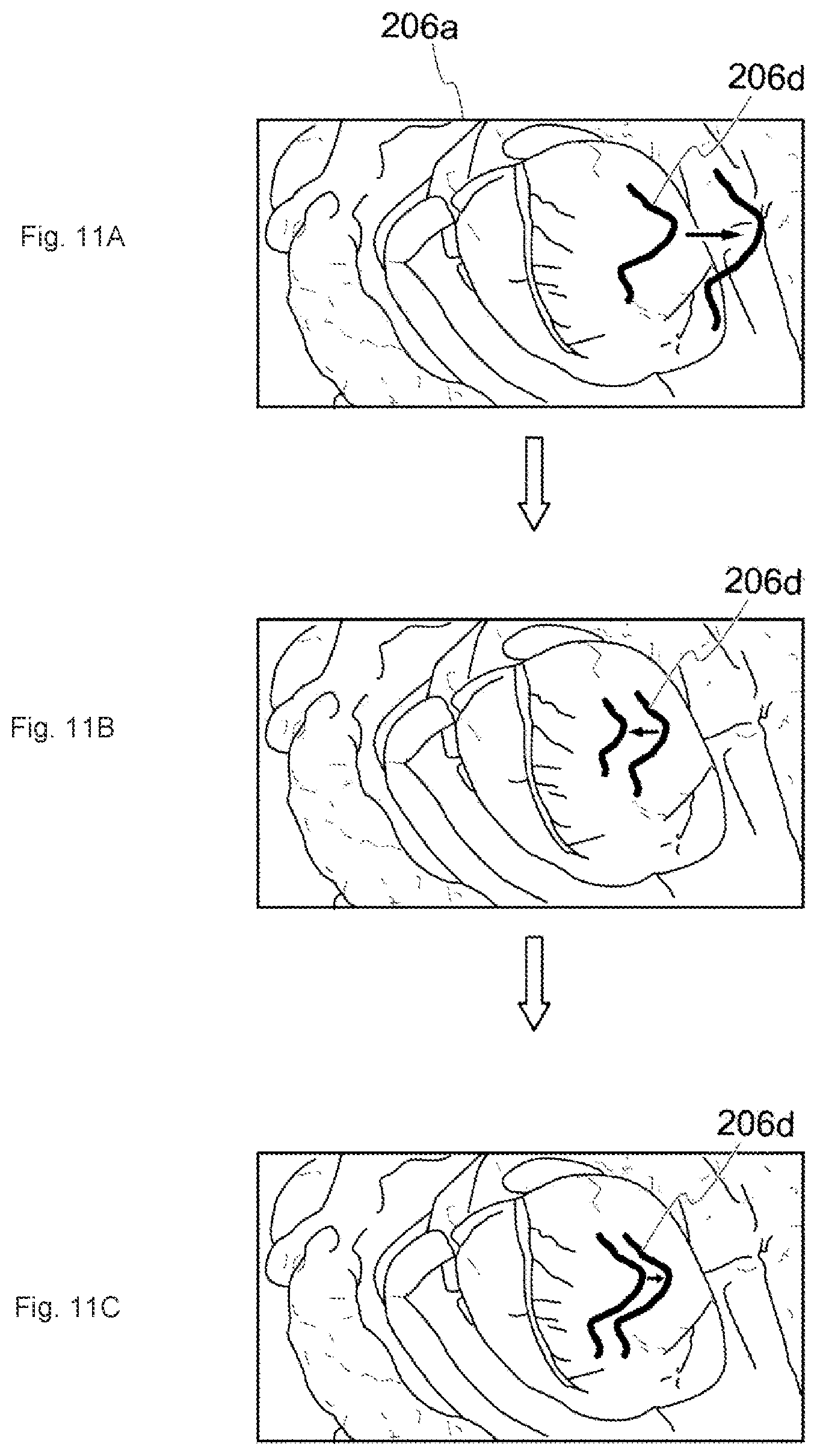 Patent US12322049 Figure 9 – Medical image processing system, surgical image control device, and surgical image control method