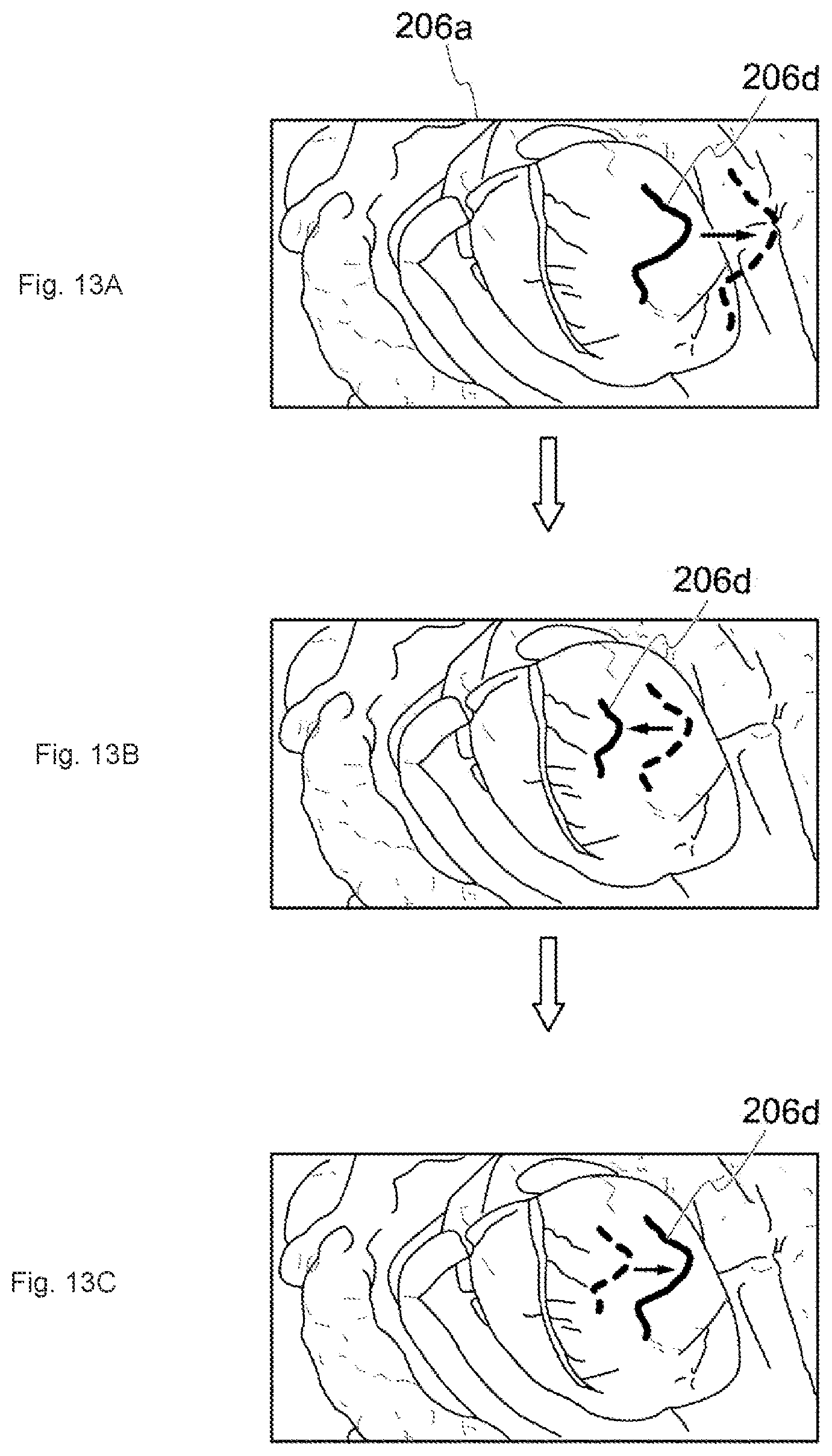 Patent US12322049 Figure 11 – Medical image processing system, surgical image control device, and surgical image control method