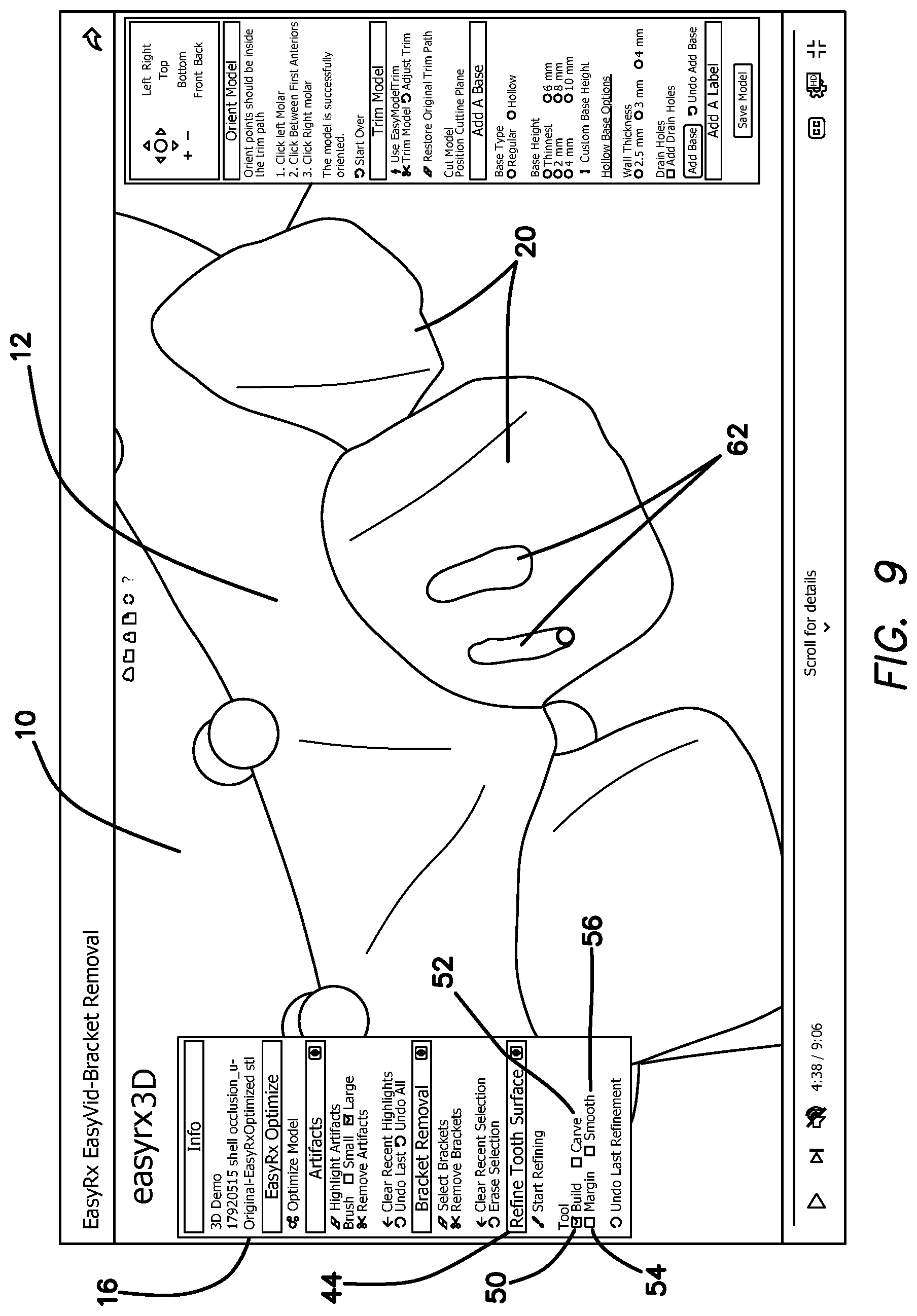 Patent US12322059 Figure 12 – System and method for removing brackets from customized orthodontic appliances and products