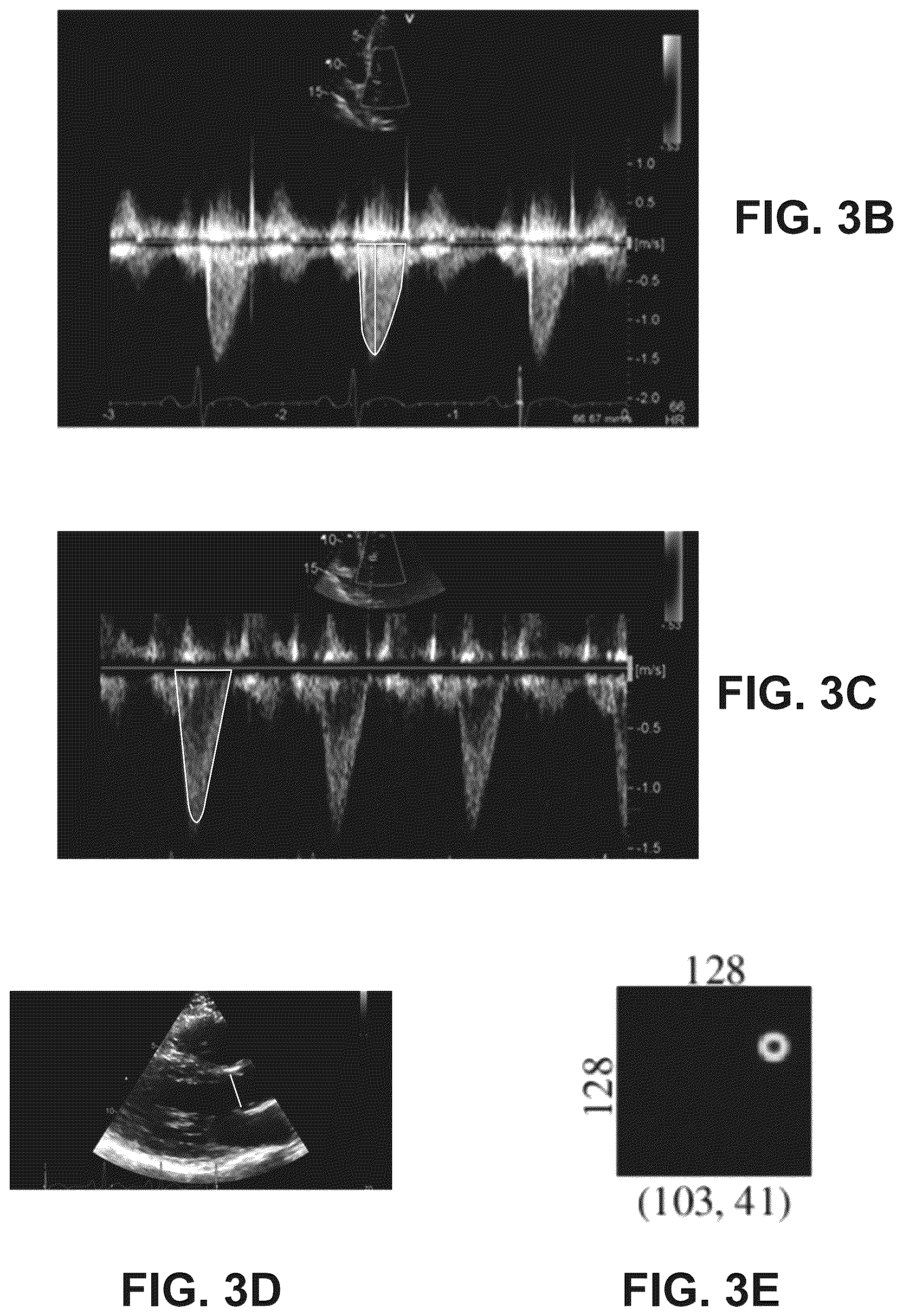 Patent US12322100 Figure 4 – Automatic clinical workflow that recognizes and analyzes 2D and doppler modality echocardiogram images for automated cardiac measurements and grading of aortic stenosis severity