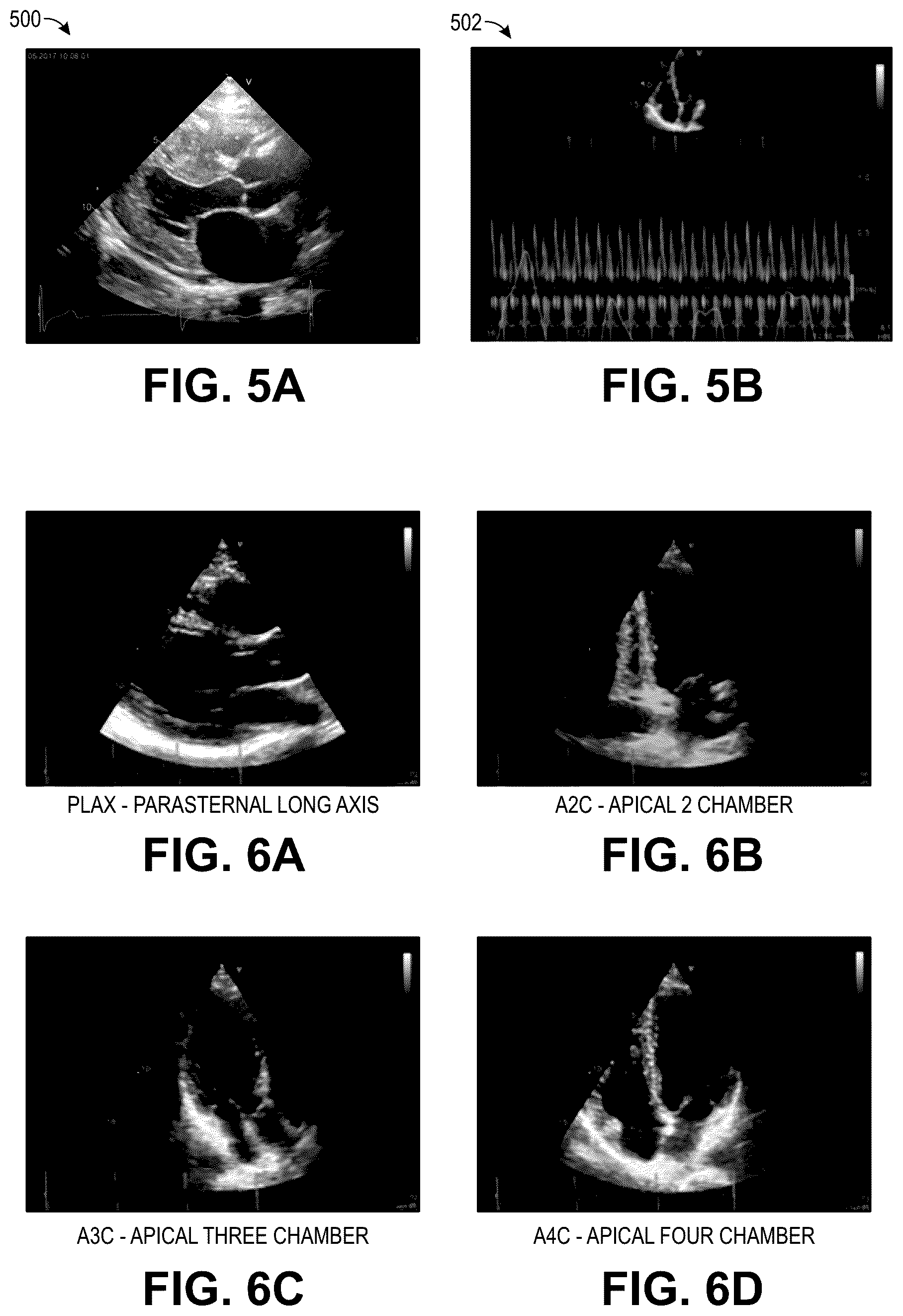 Patent US12322100 Figure 11 – Automatic clinical workflow that recognizes and analyzes 2D and doppler modality echocardiogram images for automated cardiac measurements and grading of aortic stenosis severity