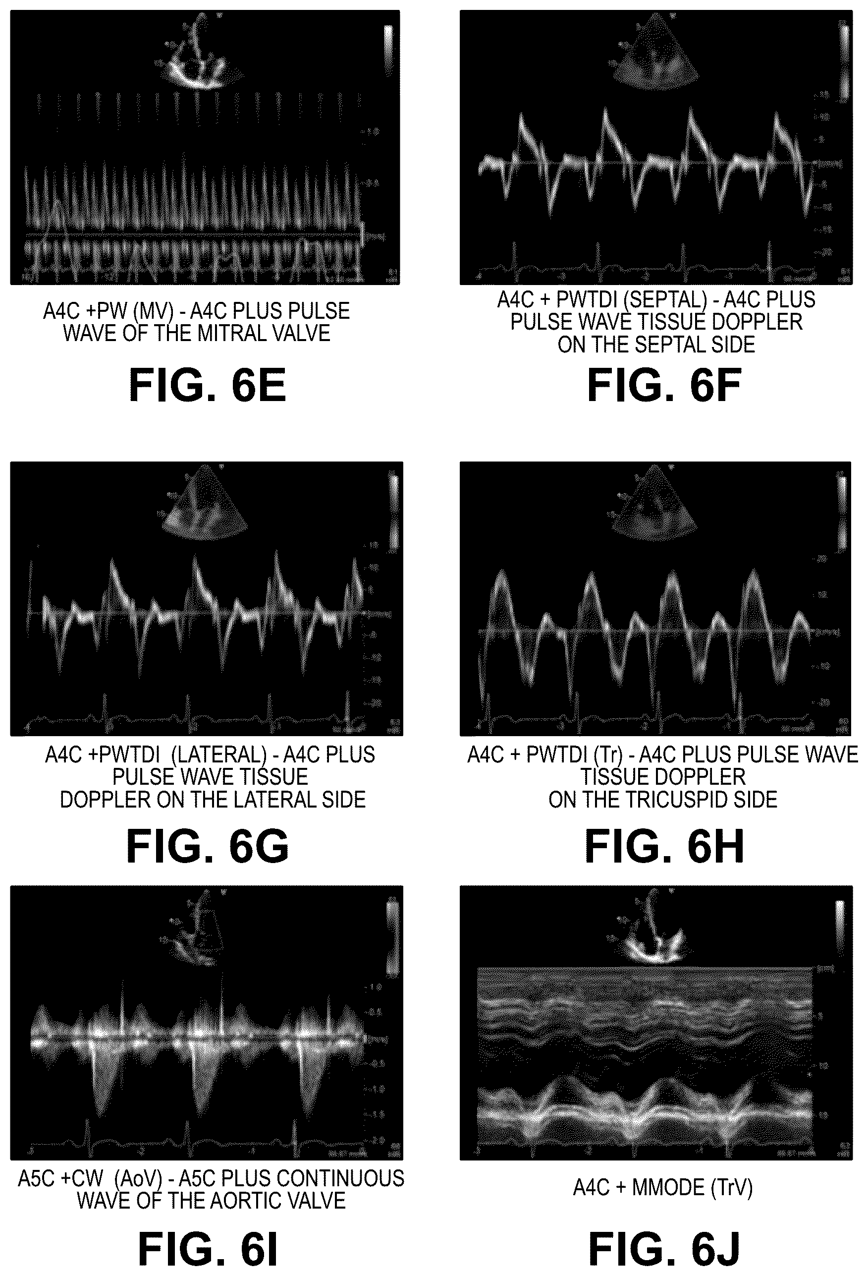Patent US12322100 Figure 12 – Automatic clinical workflow that recognizes and analyzes 2D and doppler modality echocardiogram images for automated cardiac measurements and grading of aortic stenosis severity
