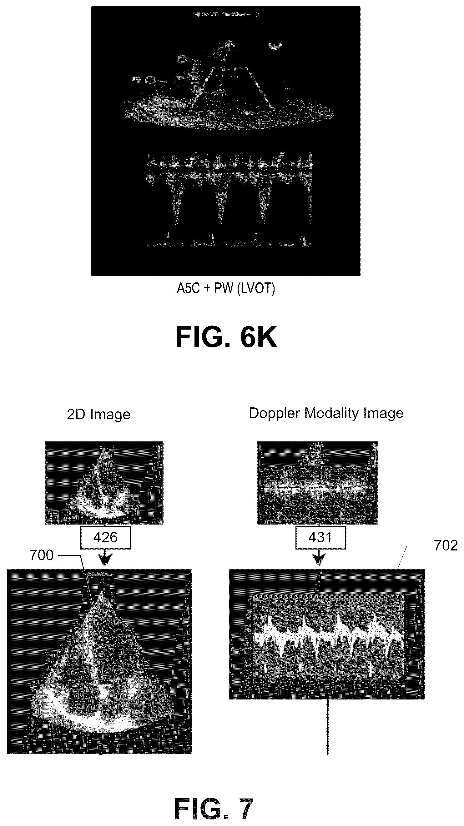 Patent US12322100 Figure 13 – Automatic clinical workflow that recognizes and analyzes 2D and doppler modality echocardiogram images for automated cardiac measurements and grading of aortic stenosis severity