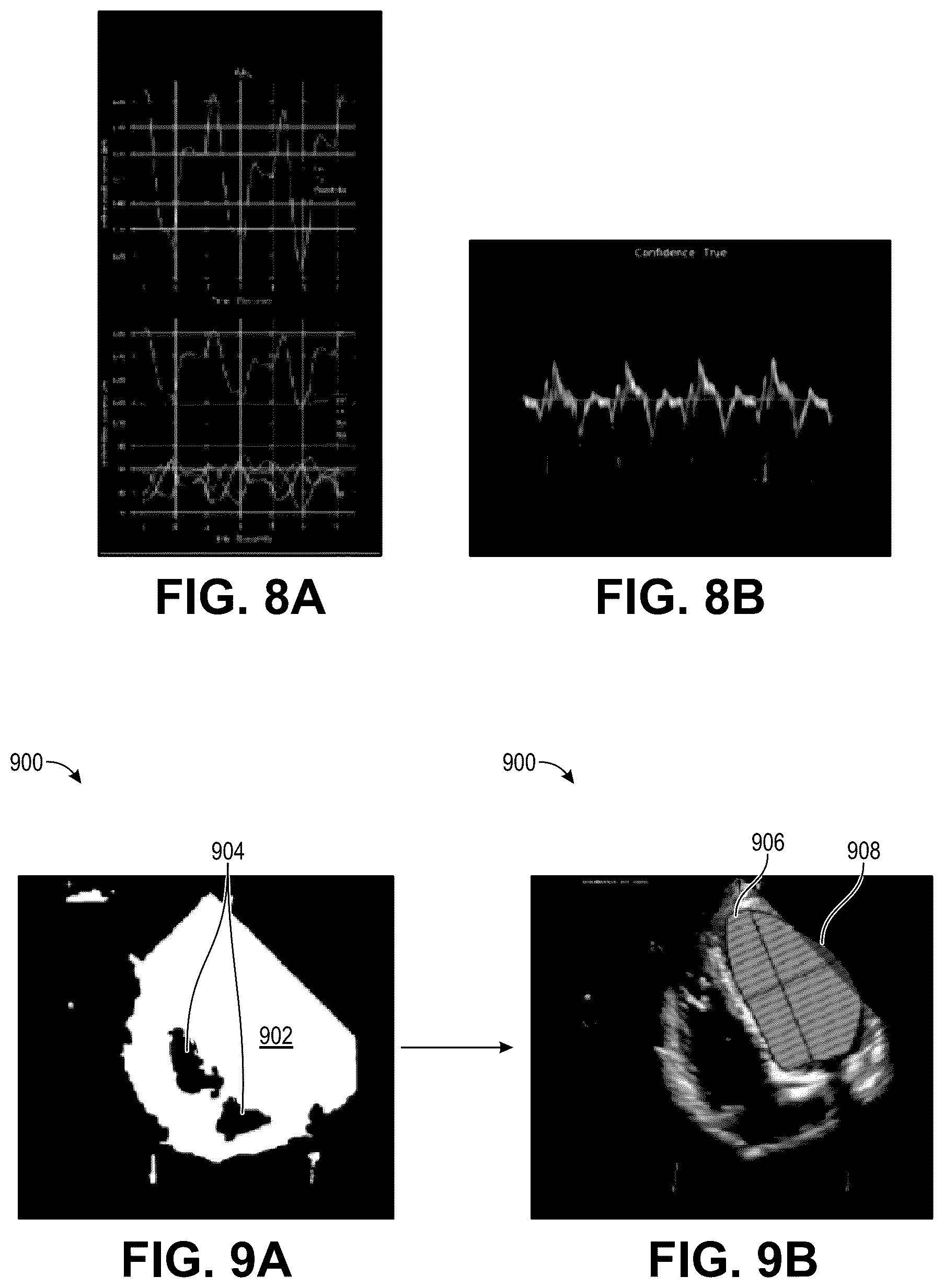 Patent US12322100 Figure 14 – Automatic clinical workflow that recognizes and analyzes 2D and doppler modality echocardiogram images for automated cardiac measurements and grading of aortic stenosis severity