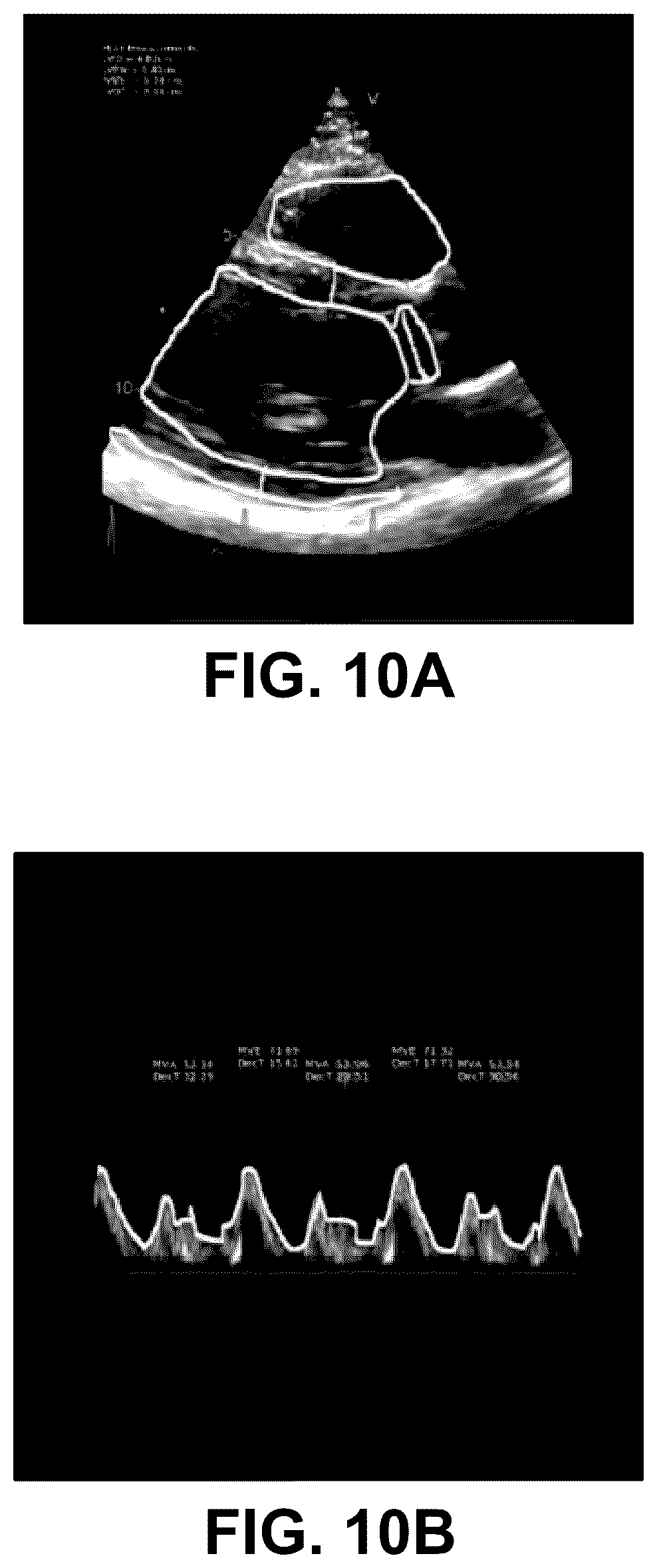 Patent US12322100 Figure 15 – Automatic clinical workflow that recognizes and analyzes 2D and doppler modality echocardiogram images for automated cardiac measurements and grading of aortic stenosis severity