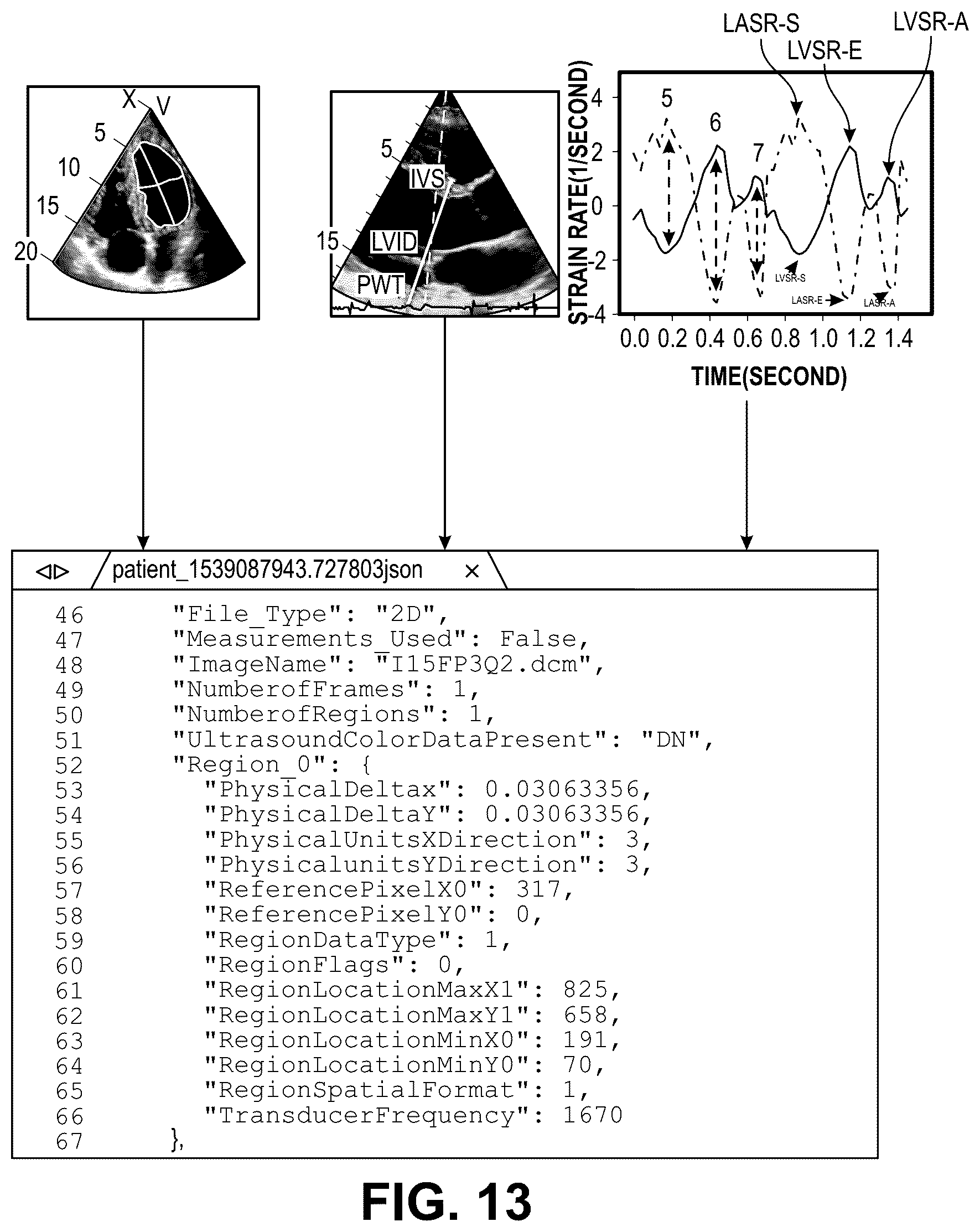 Patent US12322100 Figure 19 – Automatic clinical workflow that recognizes and analyzes 2D and doppler modality echocardiogram images for automated cardiac measurements and grading of aortic stenosis severity
