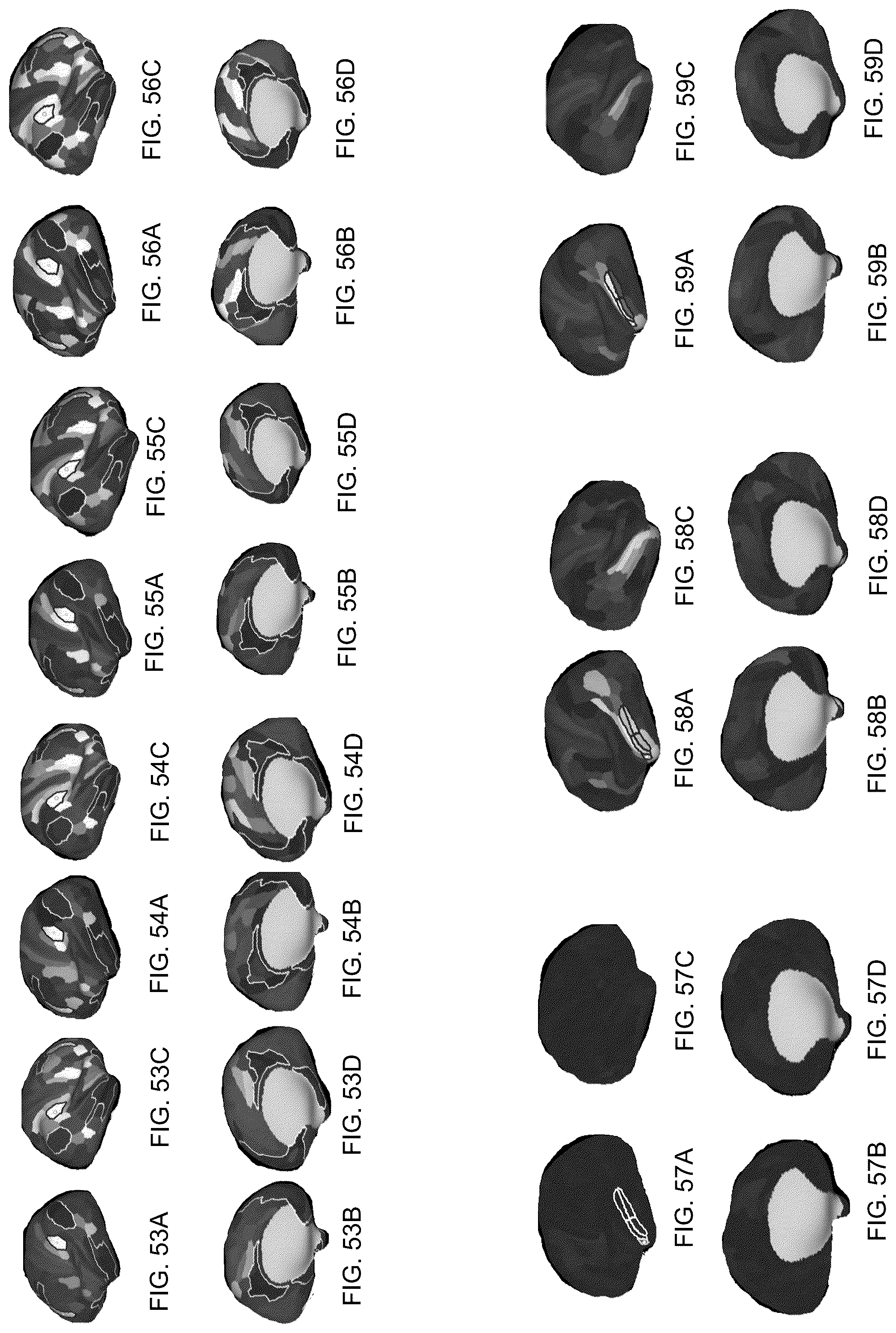 Patent US12322102 Figure 10 – Systems and methods for whole-brain circuit- based neurostimulation to treat brain disorders