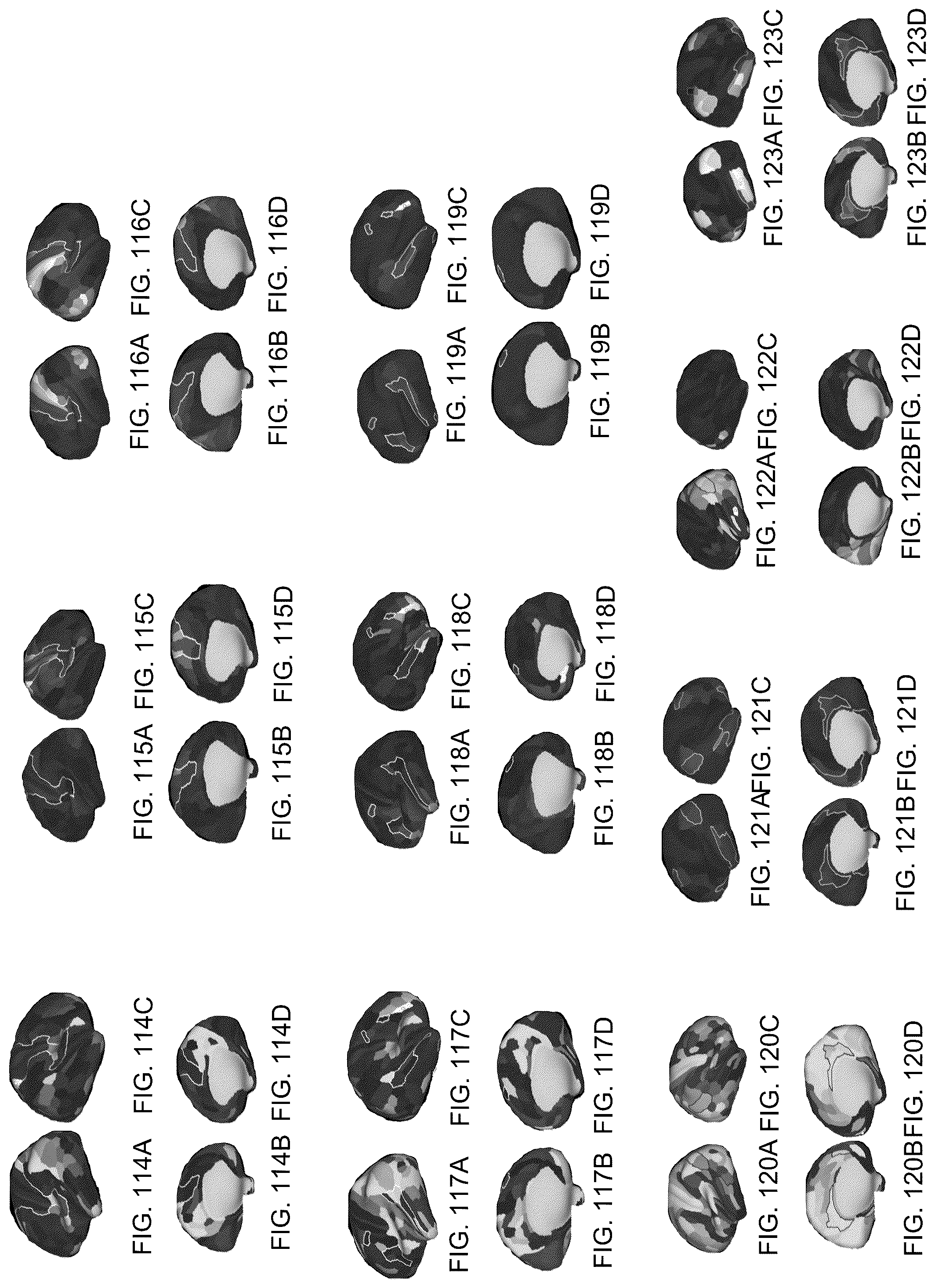 Patent US12322102 Figure 20 – Systems and methods for whole-brain circuit- based neurostimulation to treat brain disorders