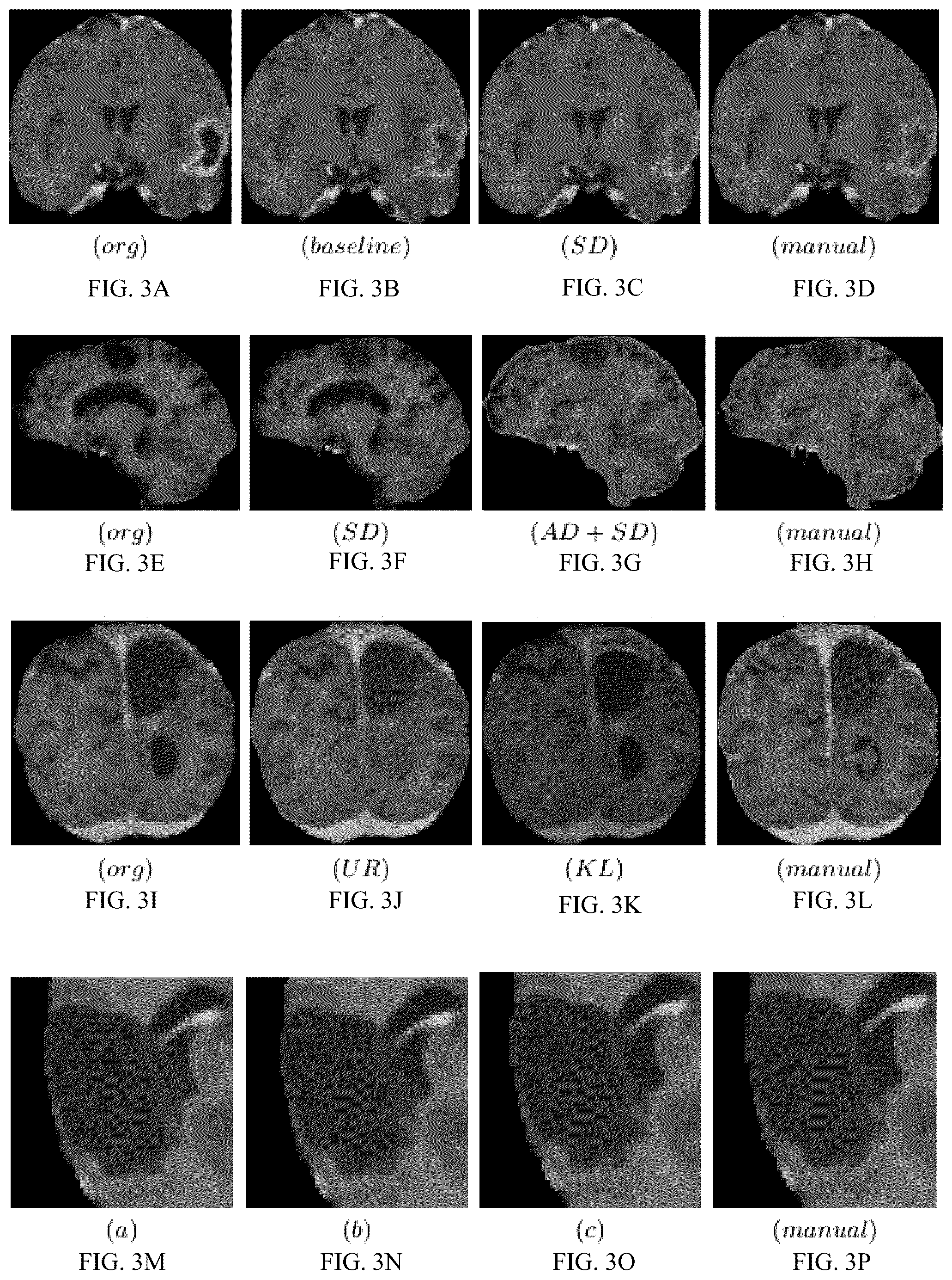 Patent US12322112 Figure 3 – Methods and apparatuses for visualization of tumor segmentation