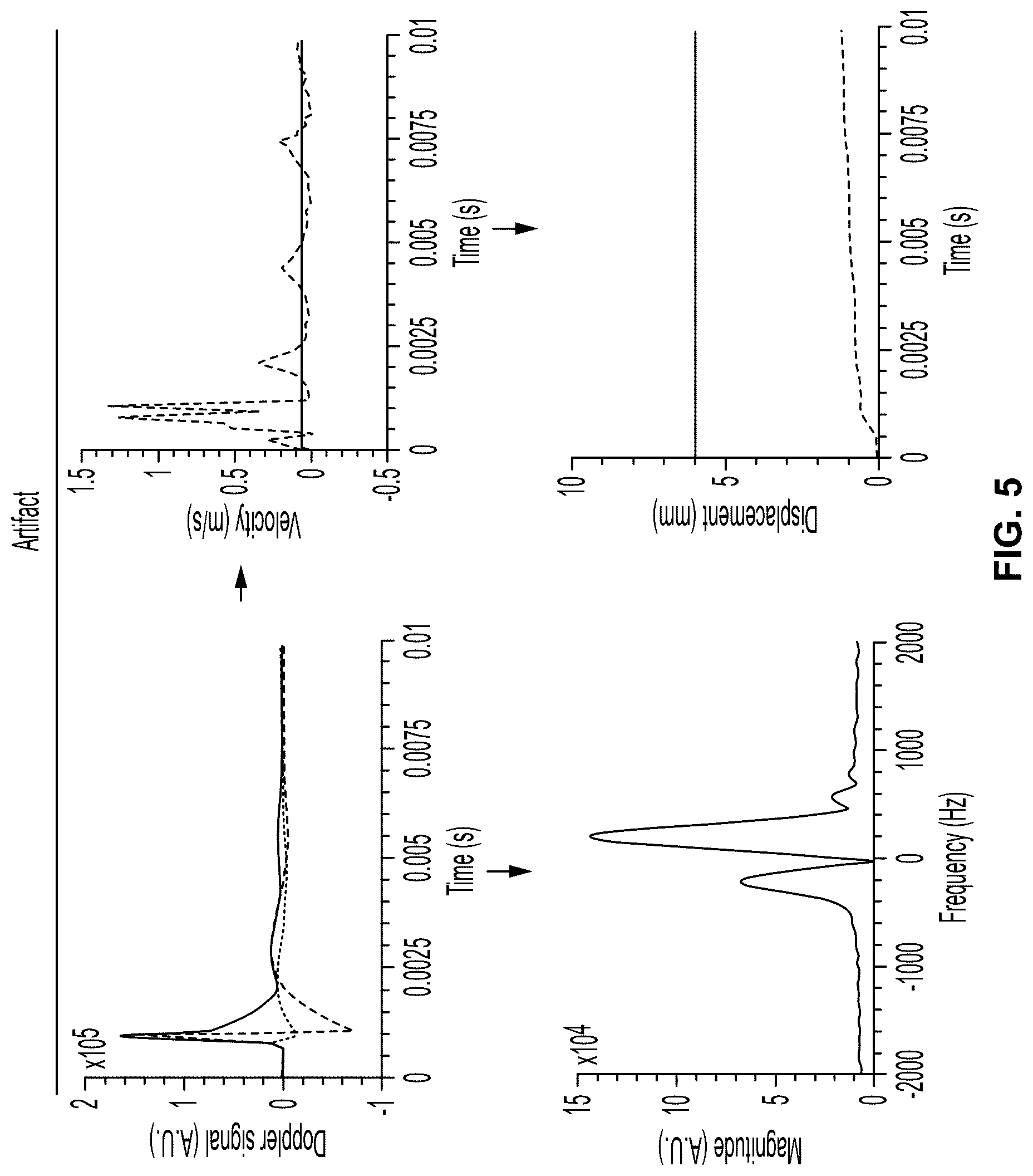 Patent US12322497 Figure 4 – Emboli detection methods to identify mechanisms of brain injury in susceptible adults and children