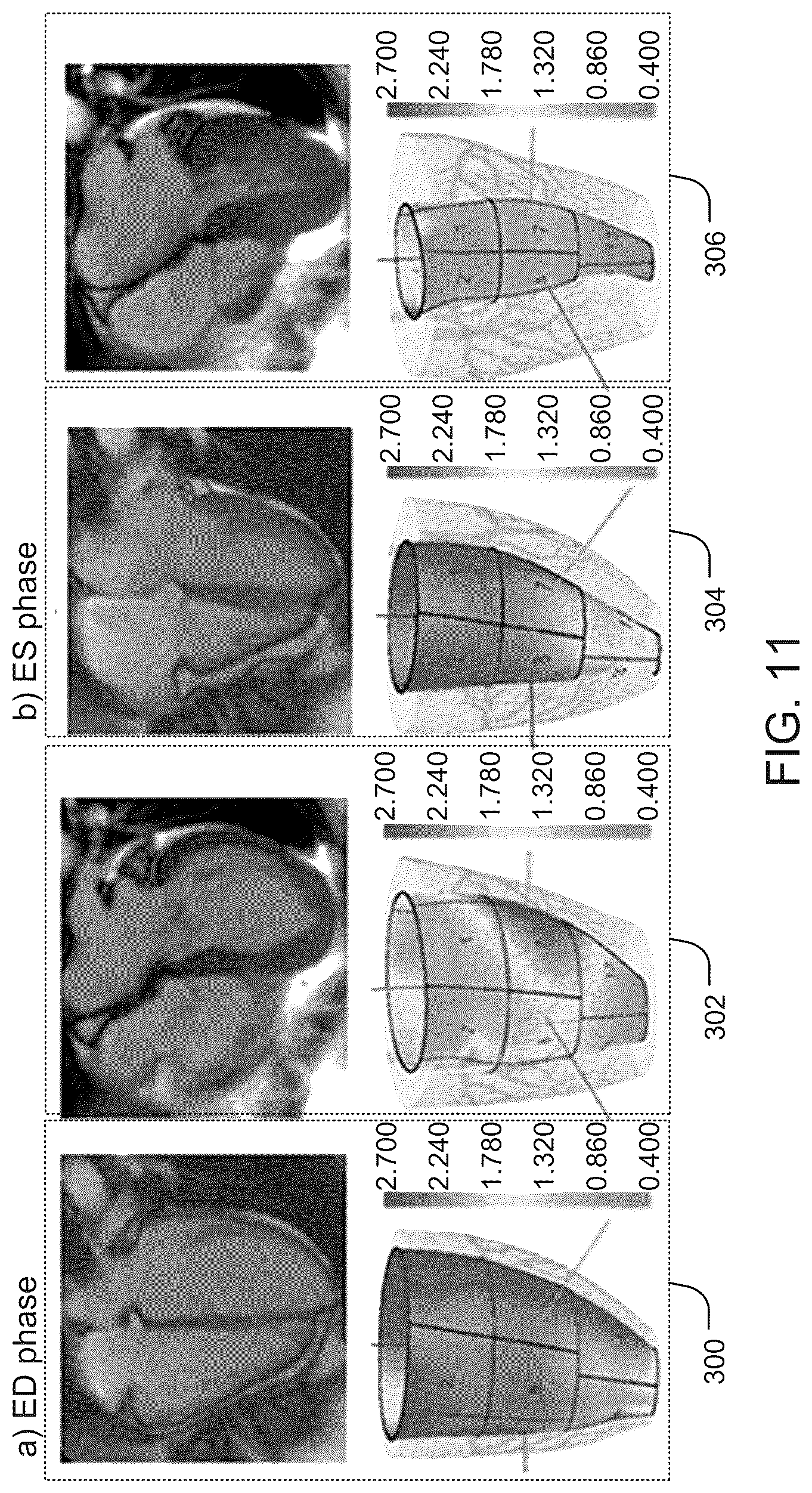 Patent US12322510 Figure 11 – Systems and methods for providing active contraction properties of the myocardium using limited clinical metrics