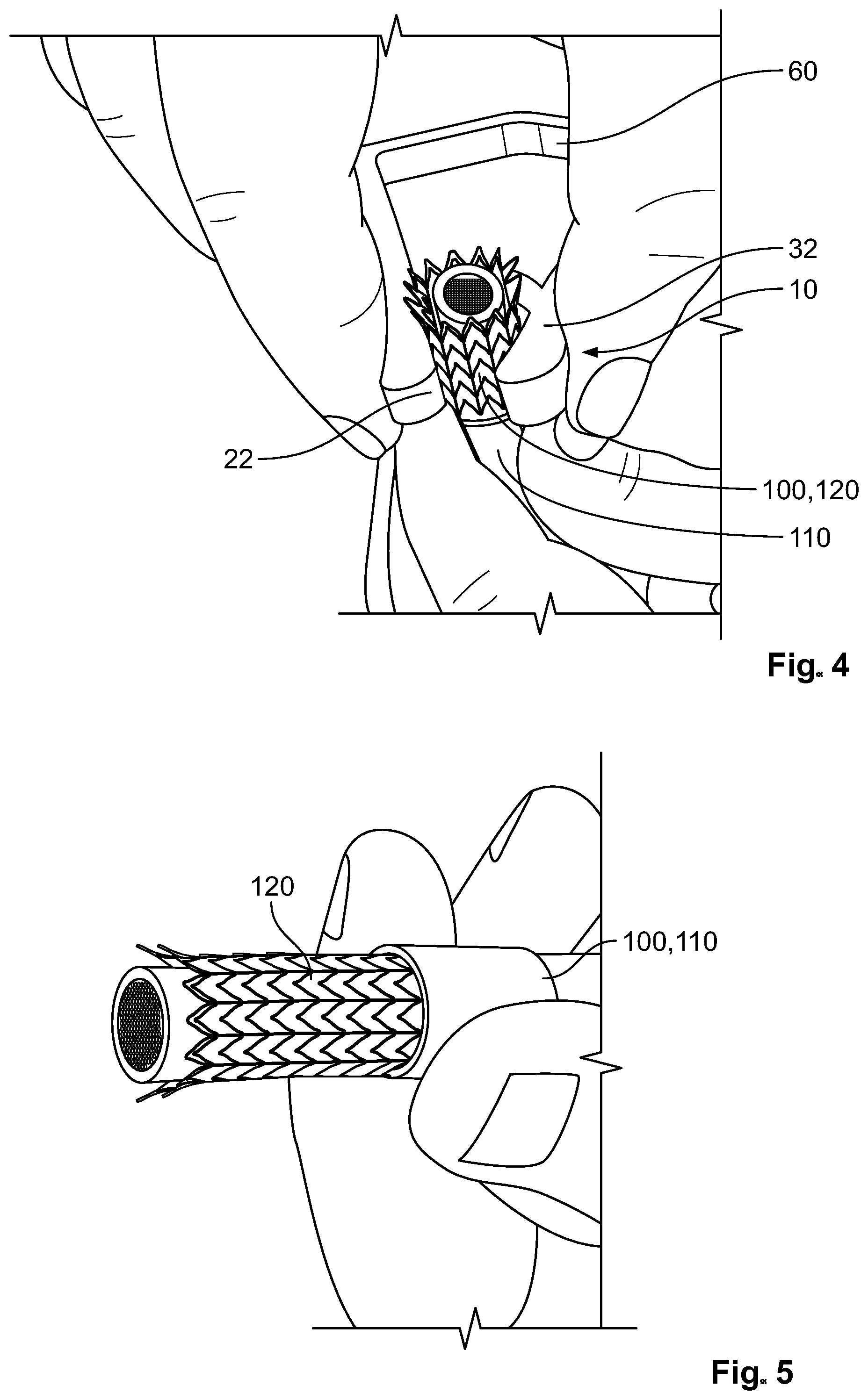 Patent US12322940 Figure 3 – Braid flare tool