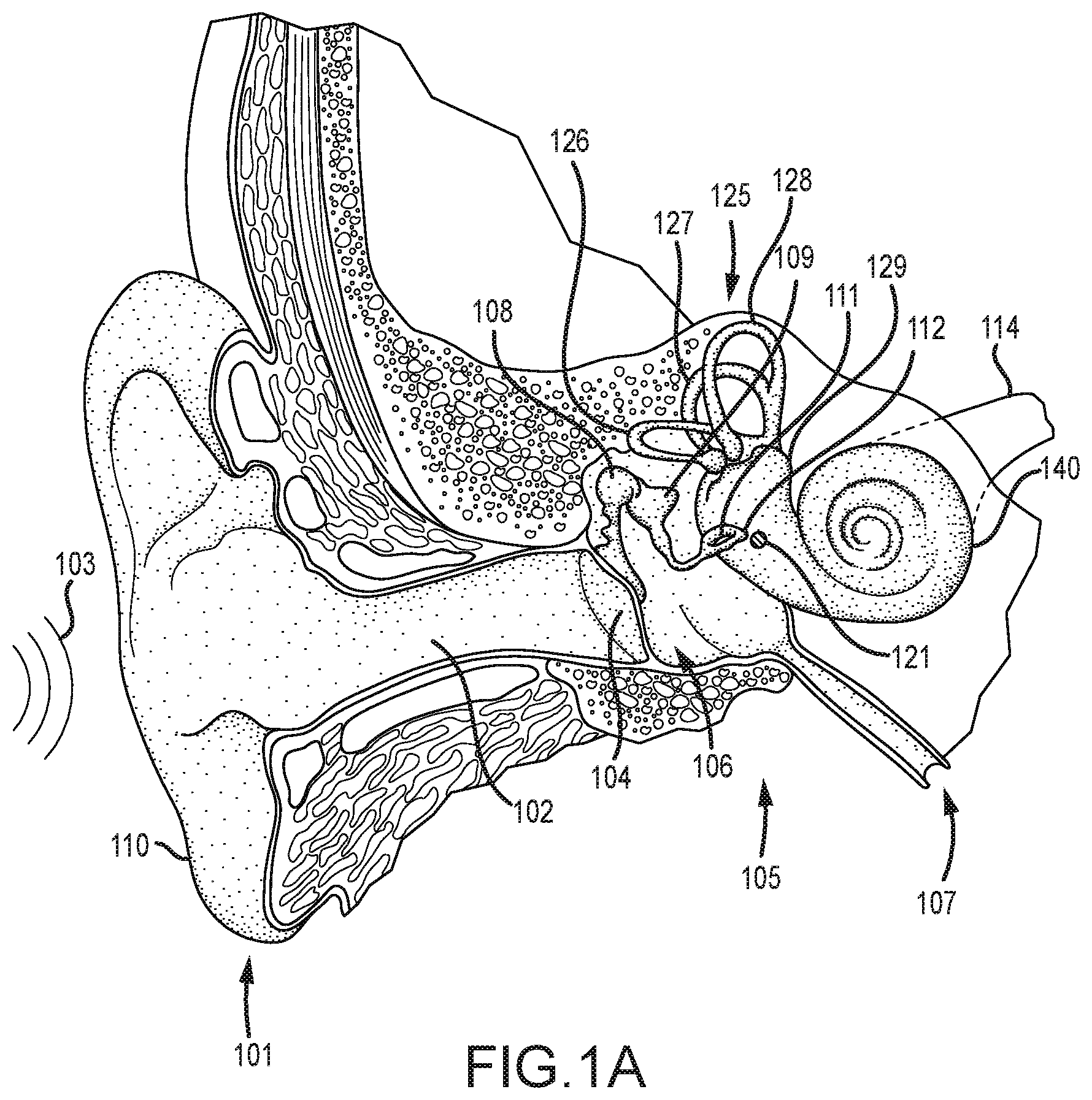 Patent US12323771 Figure 1 – Systems for accommodating separation of body parts in auditory prostheses
