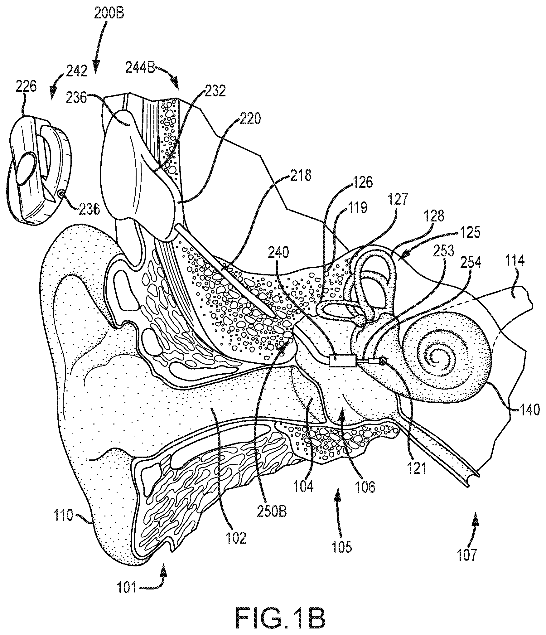 Patent US12323771 Figure 2 – Systems for accommodating separation of body parts in auditory prostheses