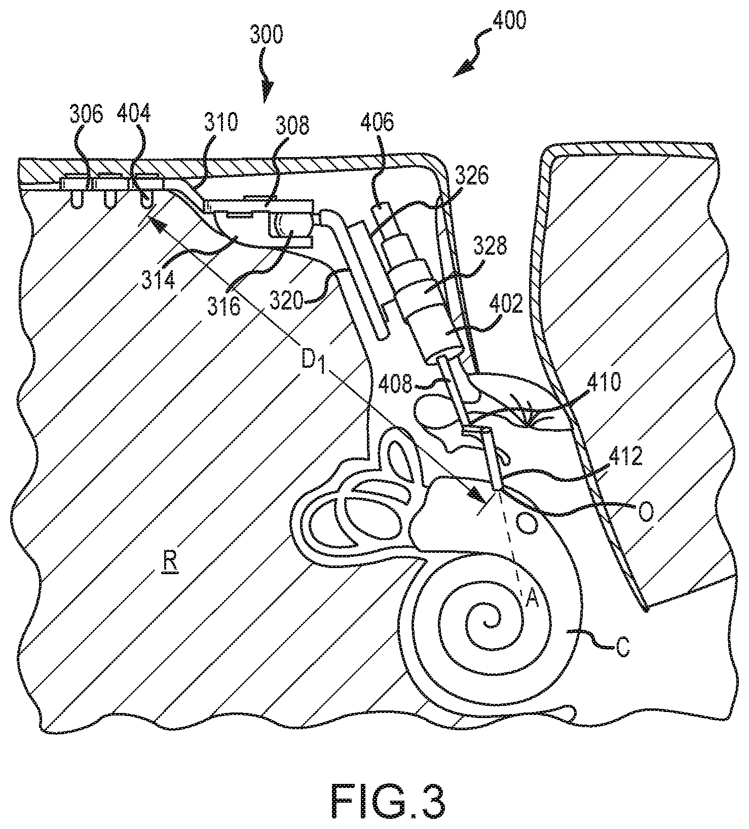Patent US12323771 Figure 5 – Systems for accommodating separation of body parts in auditory prostheses