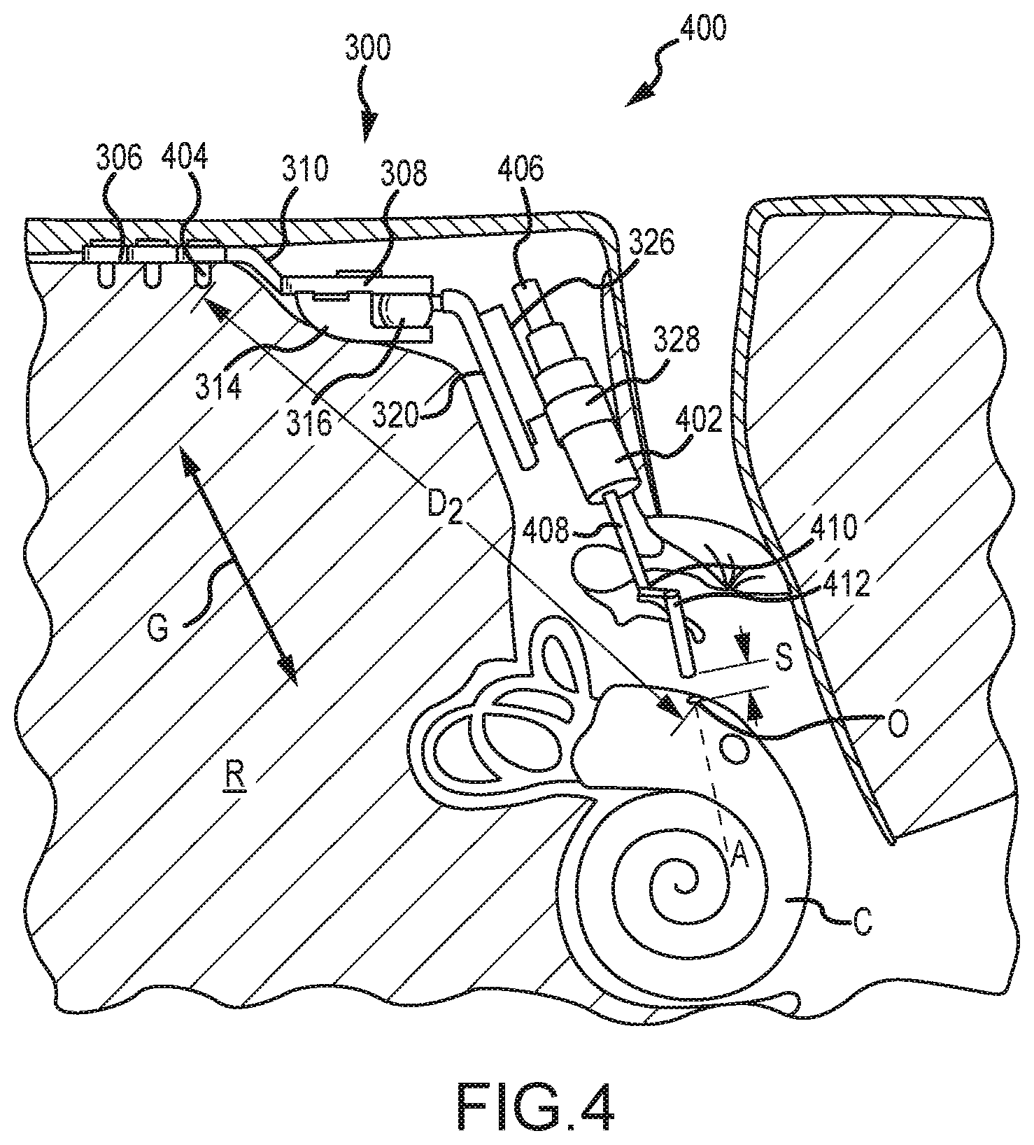 Patent US12323771 Figure 6 – Systems for accommodating separation of body parts in auditory prostheses