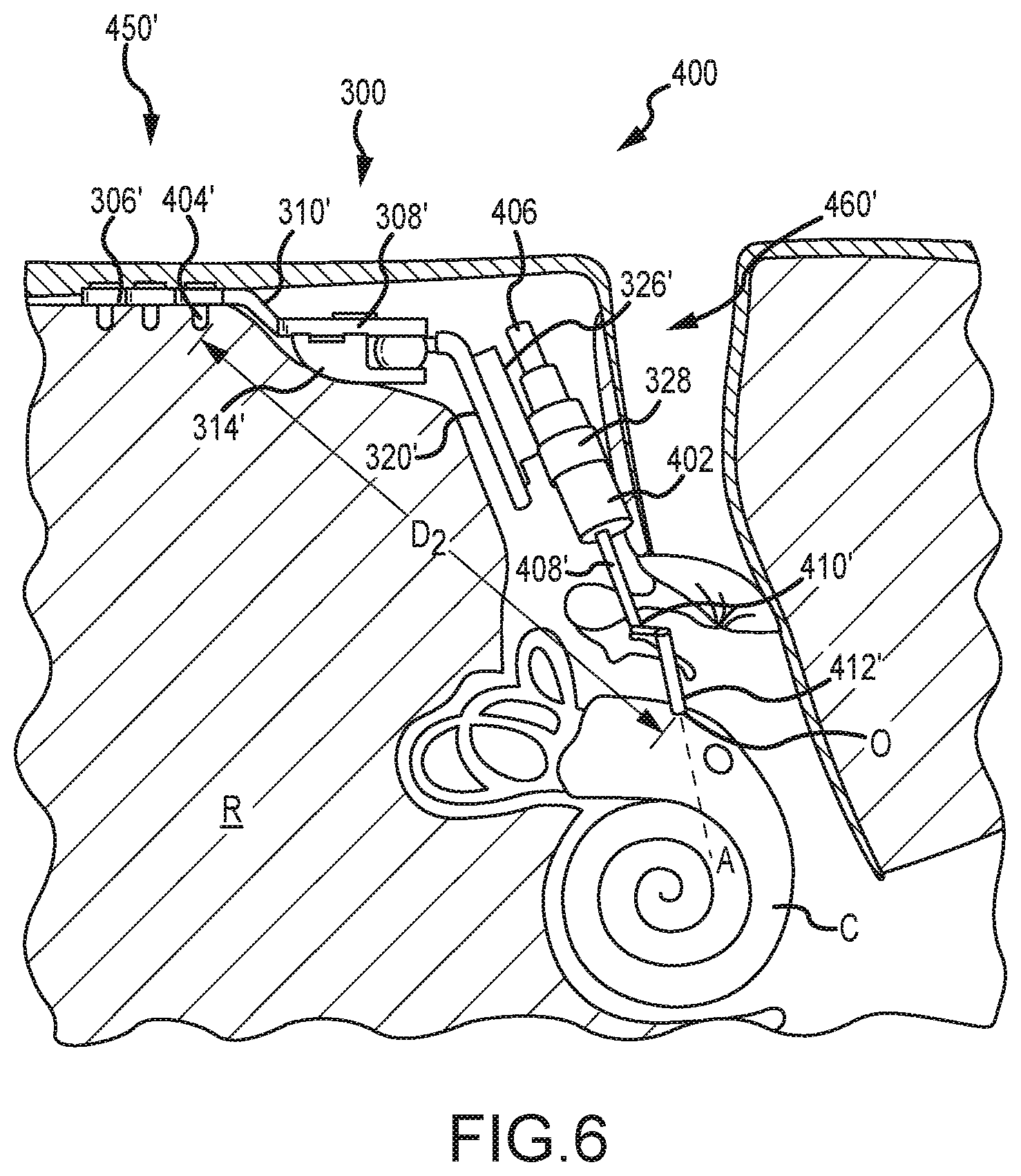 Patent US12323771 Figure 9 – Systems for accommodating separation of body parts in auditory prostheses