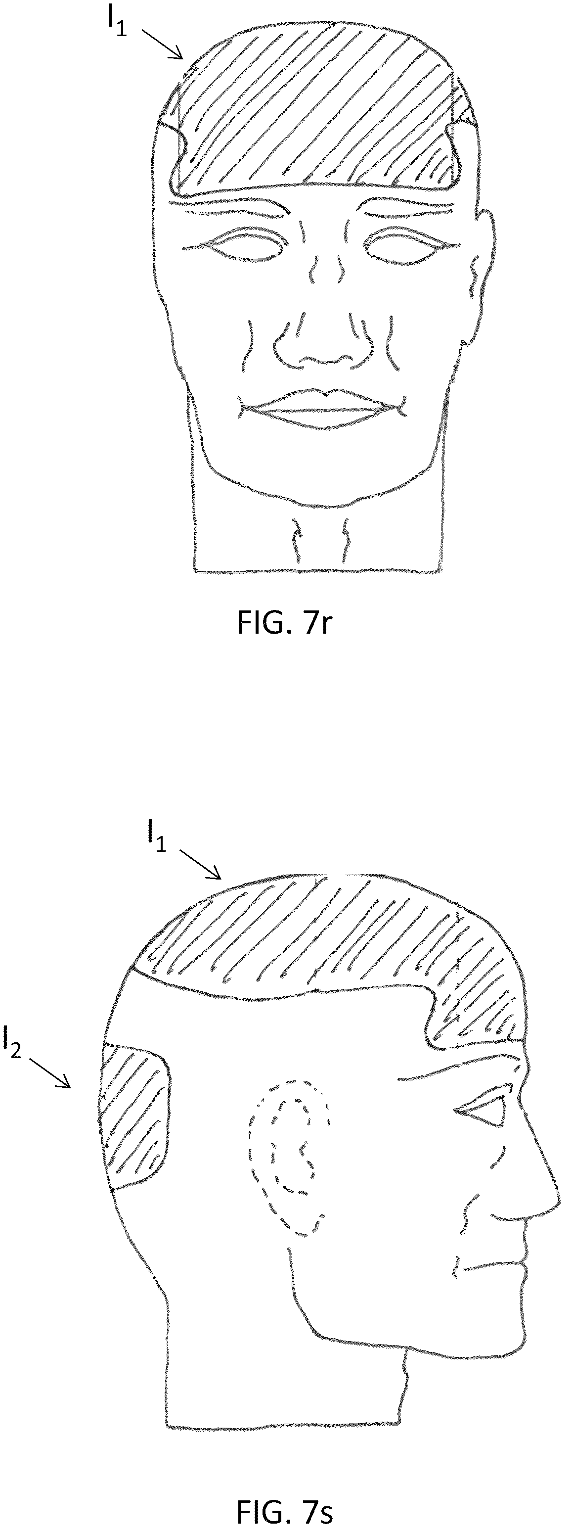 Patent US12324473 Figure 14 – Protective headgear and methods for making same